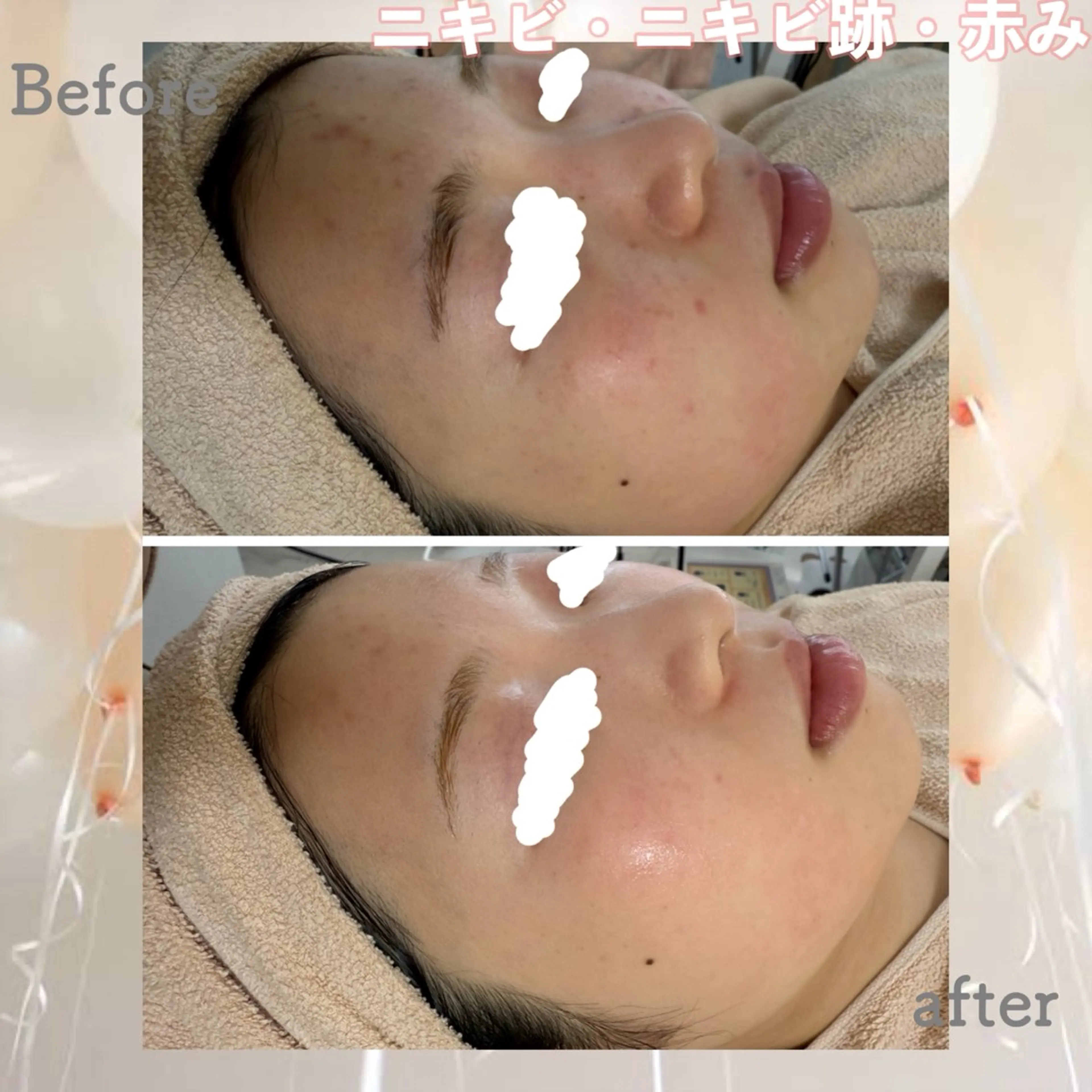 エステ ニキビ&跡改善サロン オーナー光木のエステ・リラクイメージ