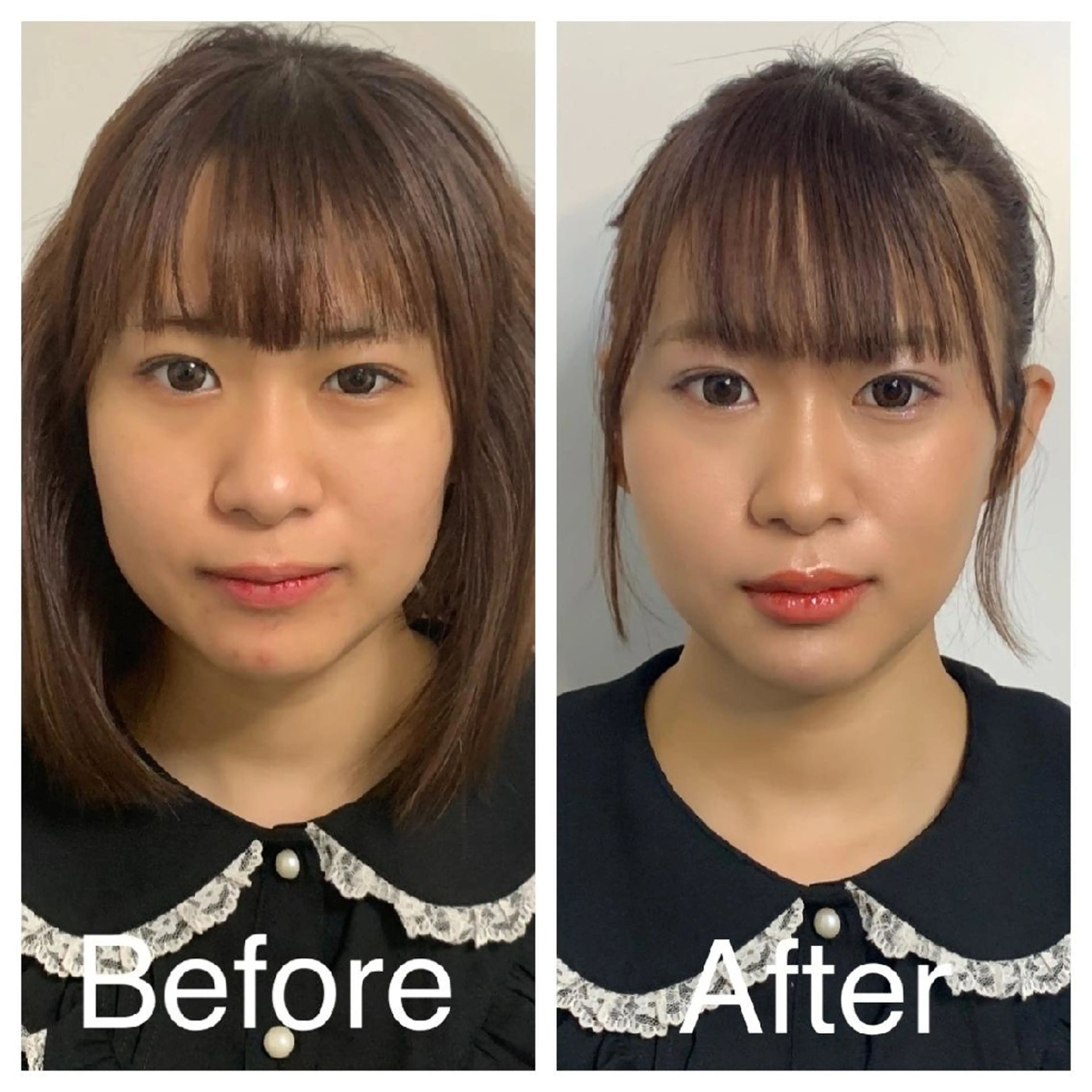 医療提携Ruby所属・医療提携Ruby小顔 ハーブピーリングのその他イメージ