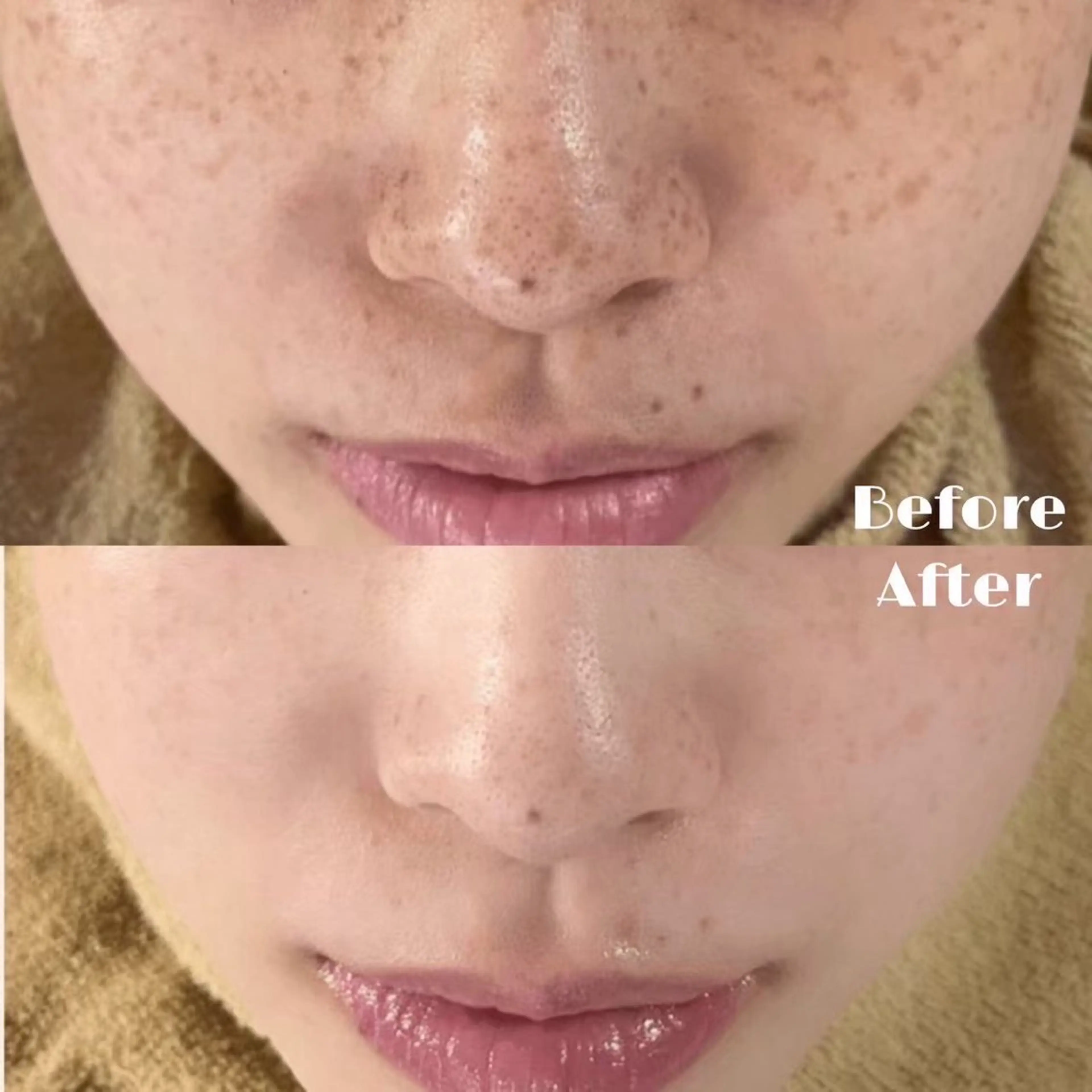 【韓国水光肌へ✨】ハーブピーリングで水光肌🫧の写真