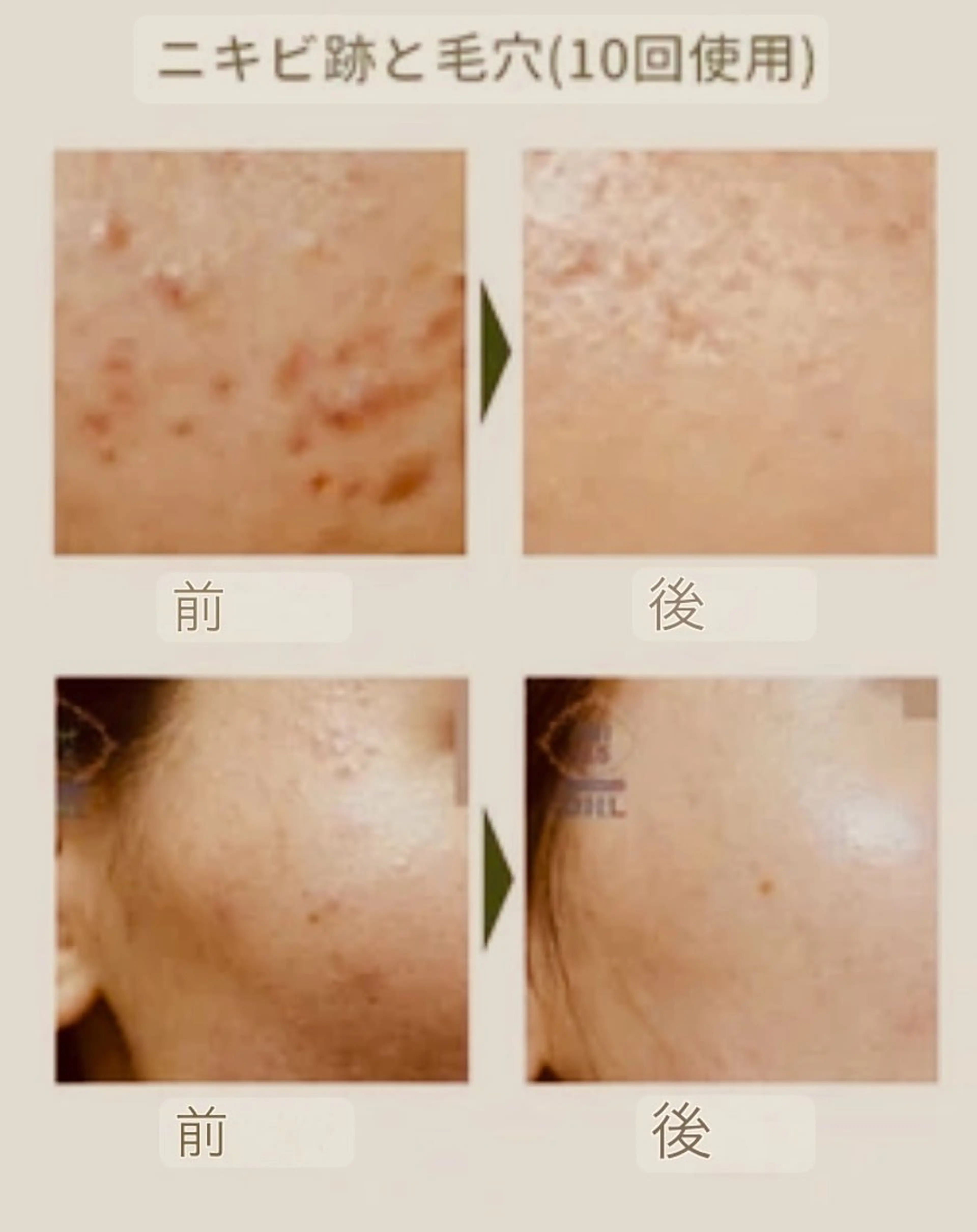 人気No.2🌿ニキビ•黒ずみ改善・剥離なし【OHLハーブピーリング🕐90】《酵素ケア×毛穴洗浄×EMS導入》の写真