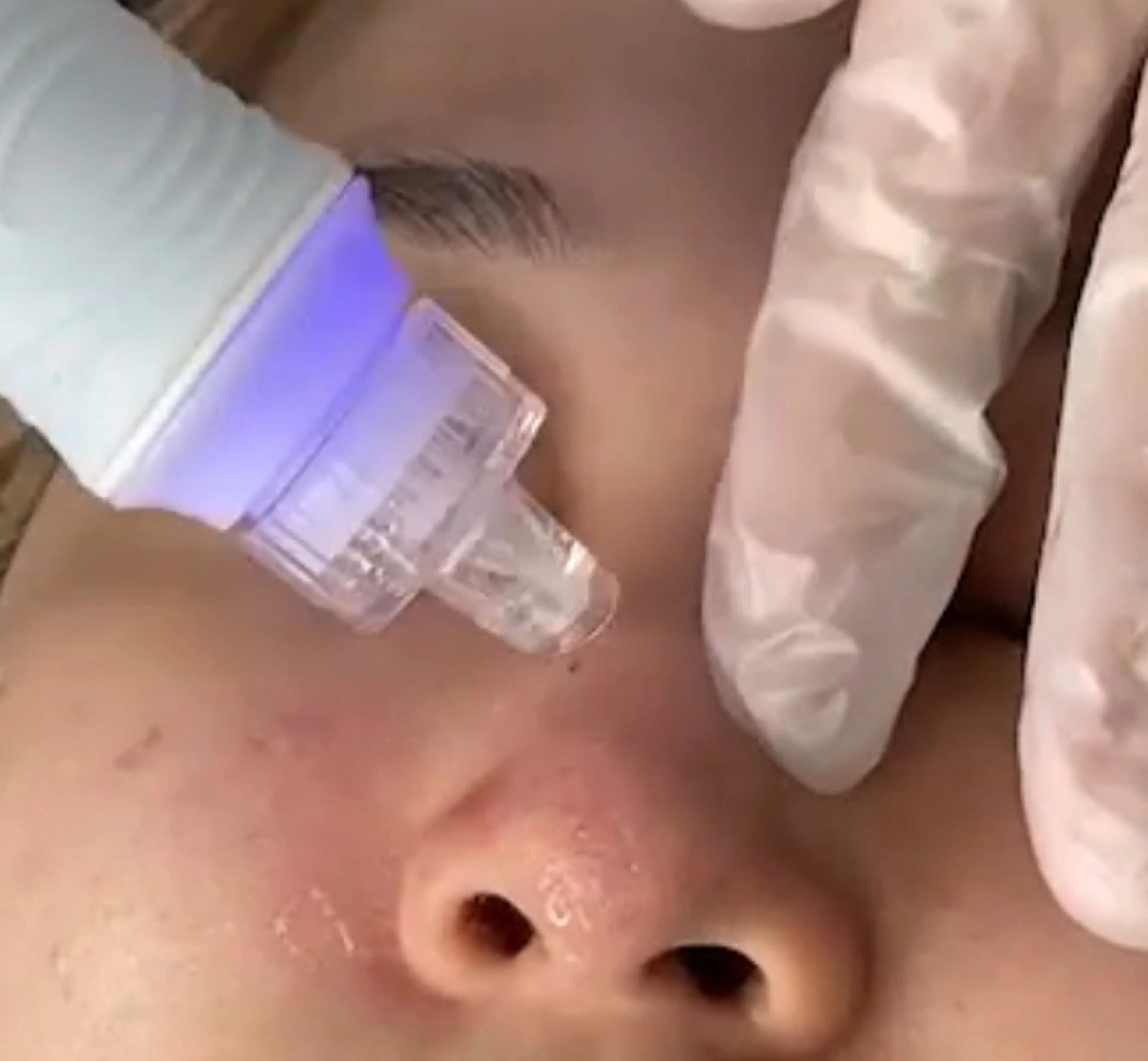 毛穴洗浄～黒ずみ・角栓・ザラつき一掃の写真