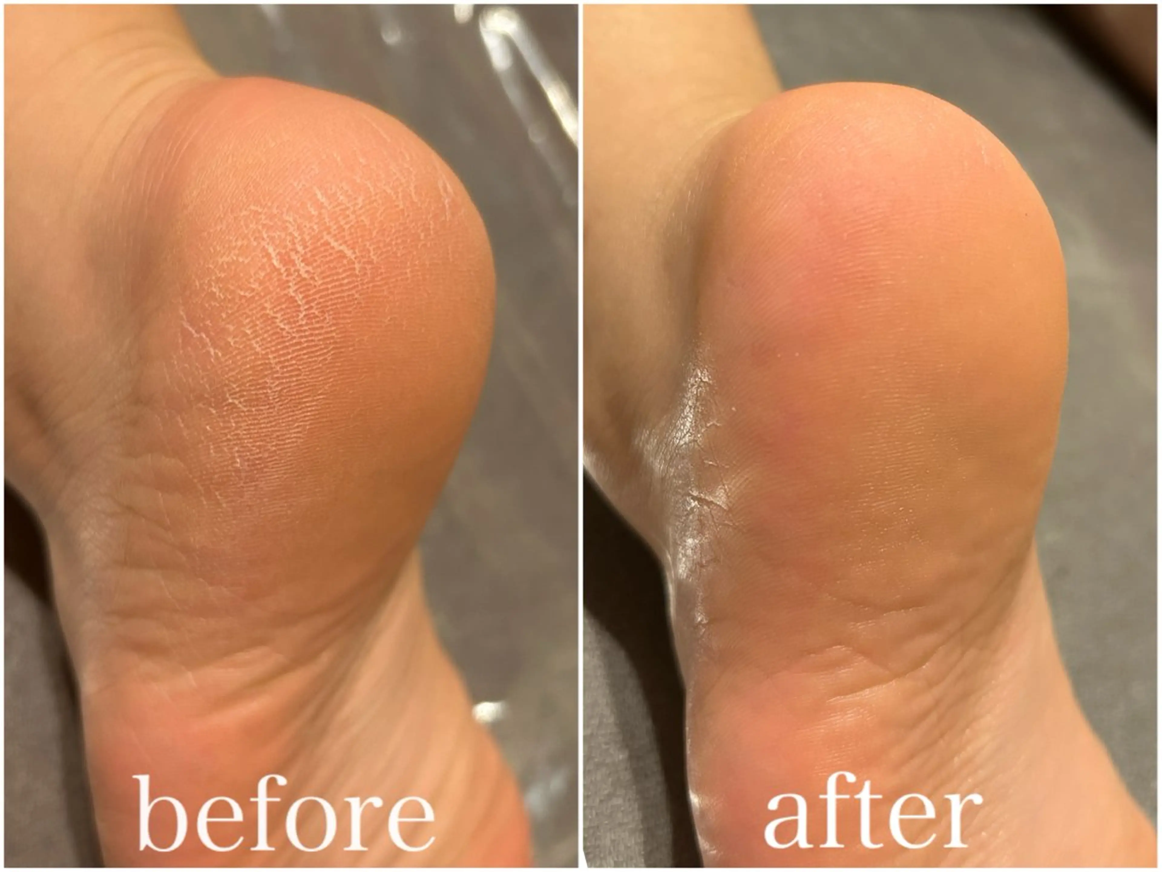 【minimo限定】ガサガサ卒業✨フット角質ケア＋膝下マッサージ50分の写真