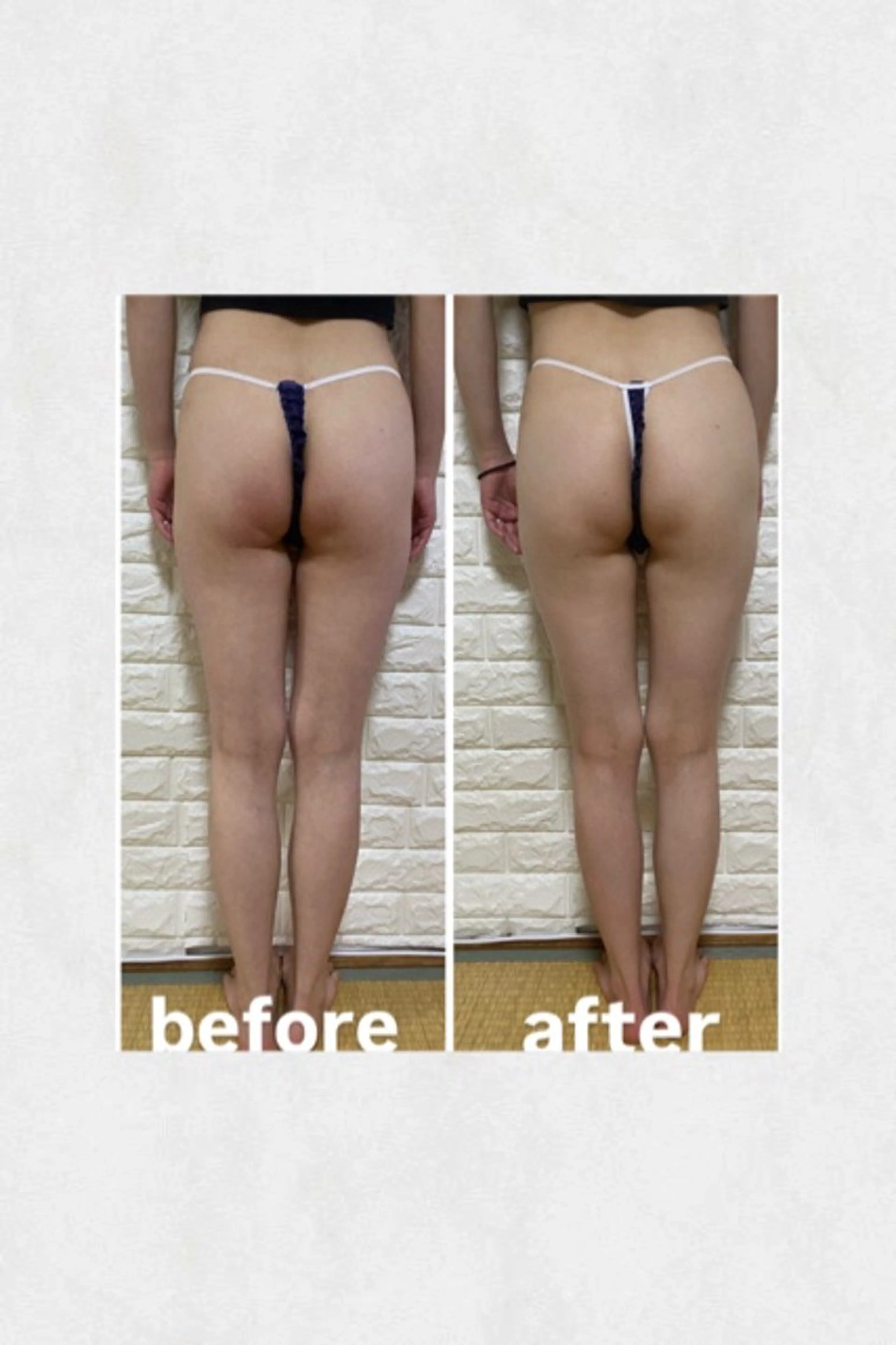 脚やせ美脚エステの写真