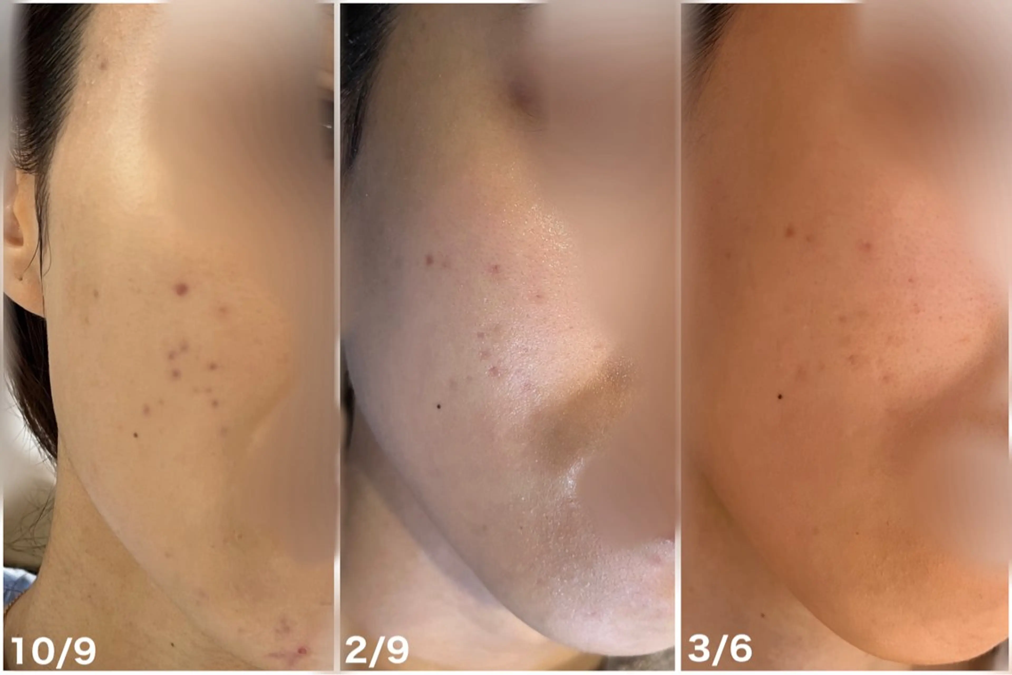 エステ 肌質改善サロン🌕 ⠀【ルーナピエナ】のエステ・リラクイメージ