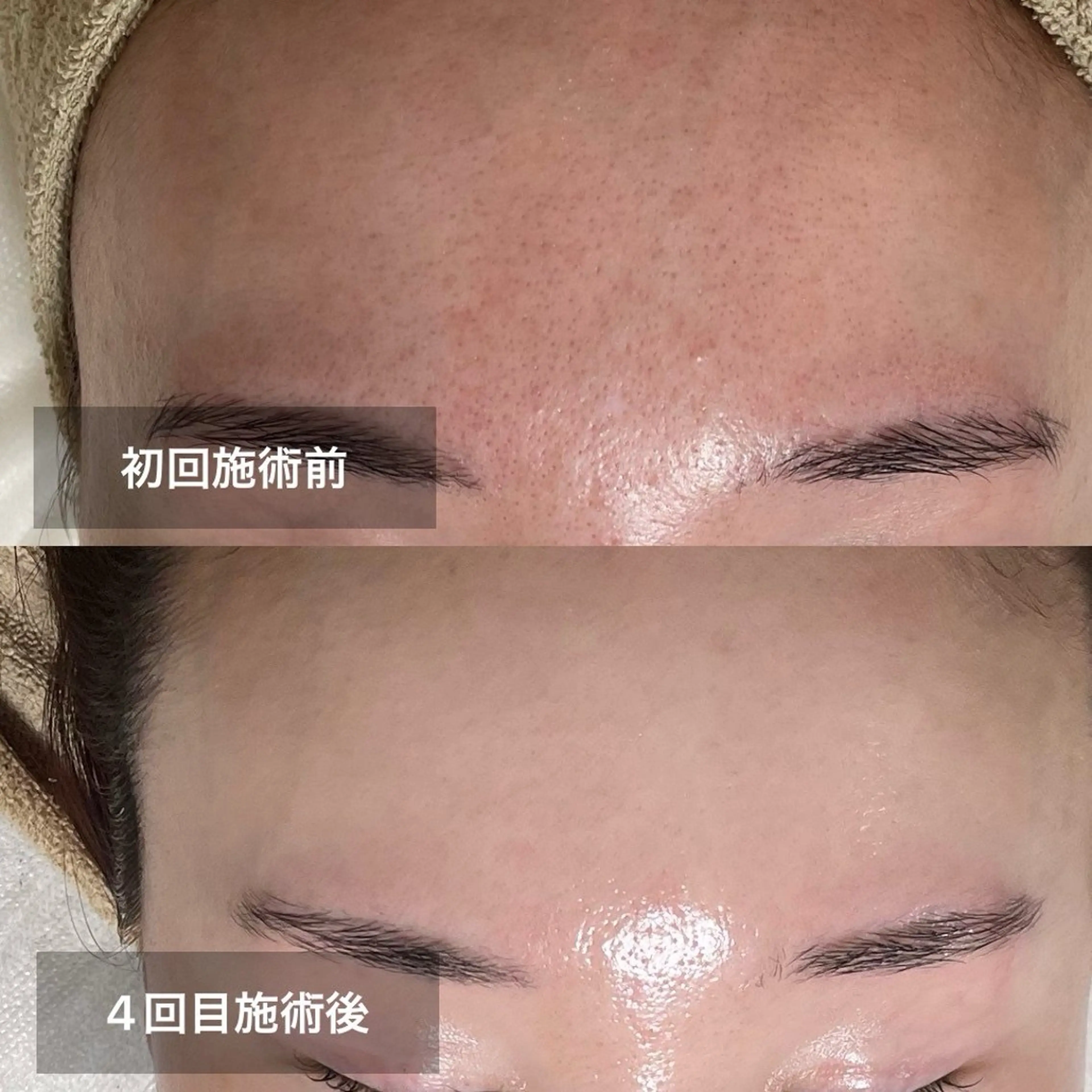 【シミケア/美白/ごわつき】REVIスペシャル幹細胞ハーブピーリングケア♪デコルテケア付き￥18150の写真