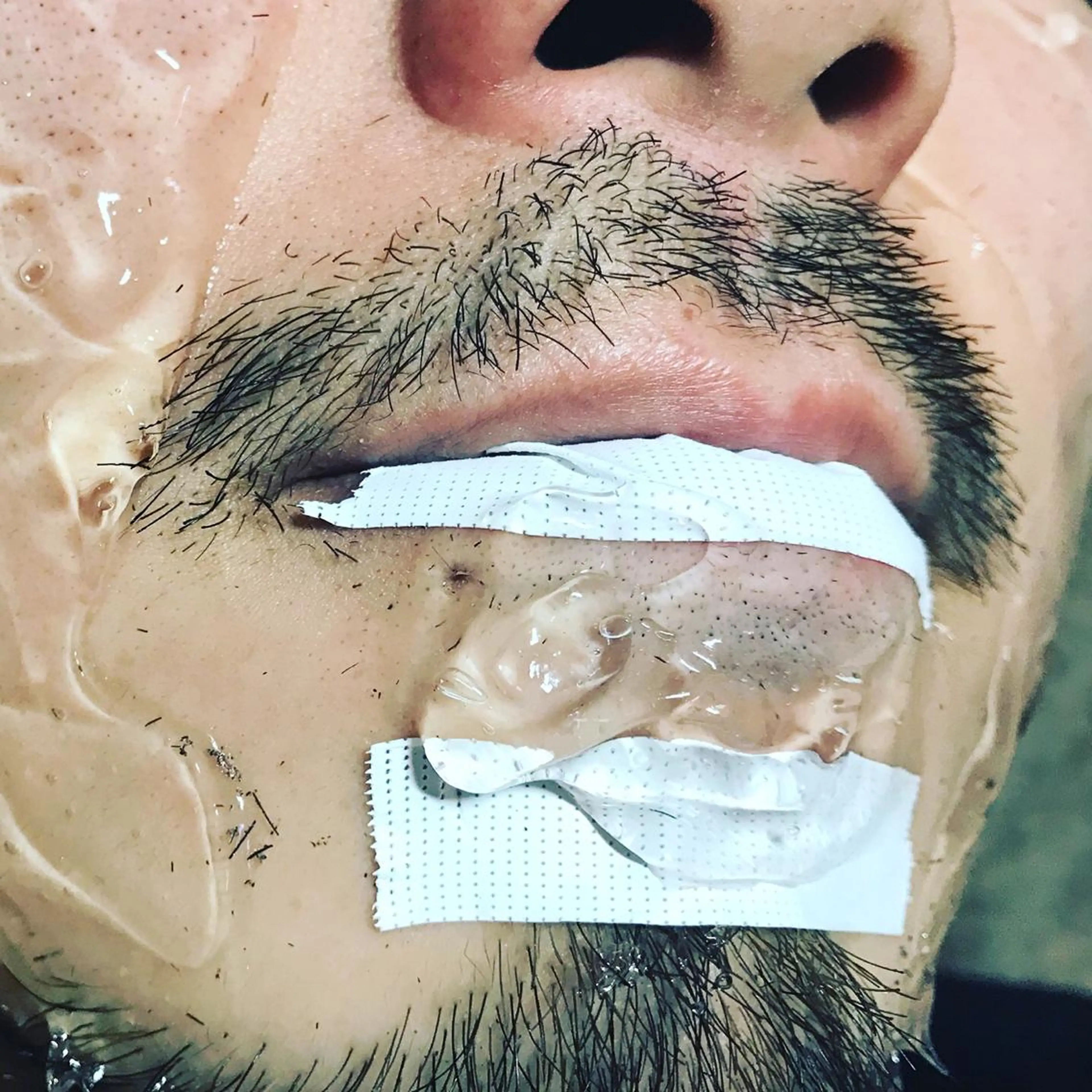 【ニミモ特価！！】メンズひげ脱毛○首からお顔全体気になる部分の写真