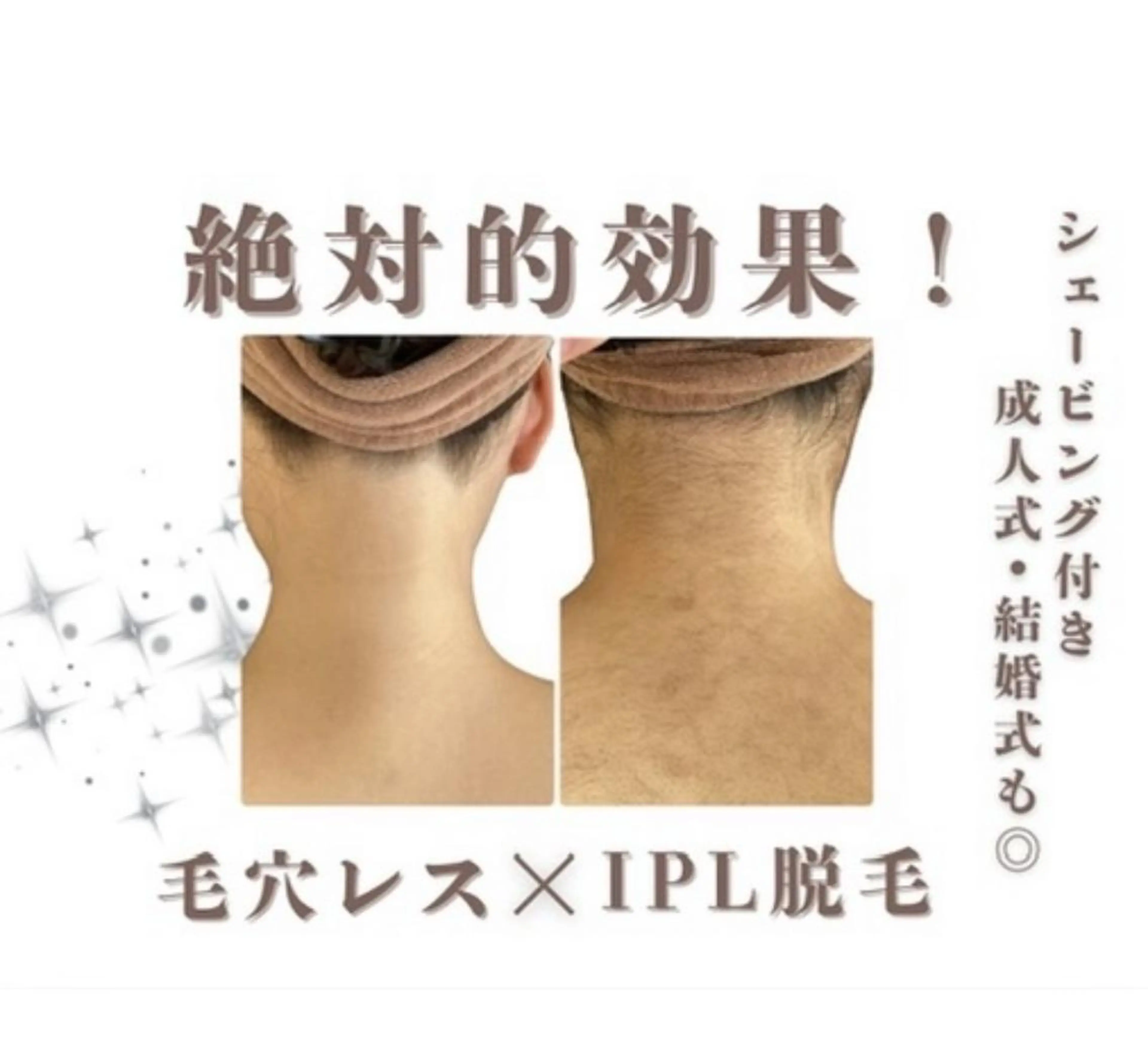 【最新機器導入】うなじ脱毛💫ー１０℃脱毛で痛みゼロ😮効果抜群✨とにかく抜ける新感覚❣️の写真