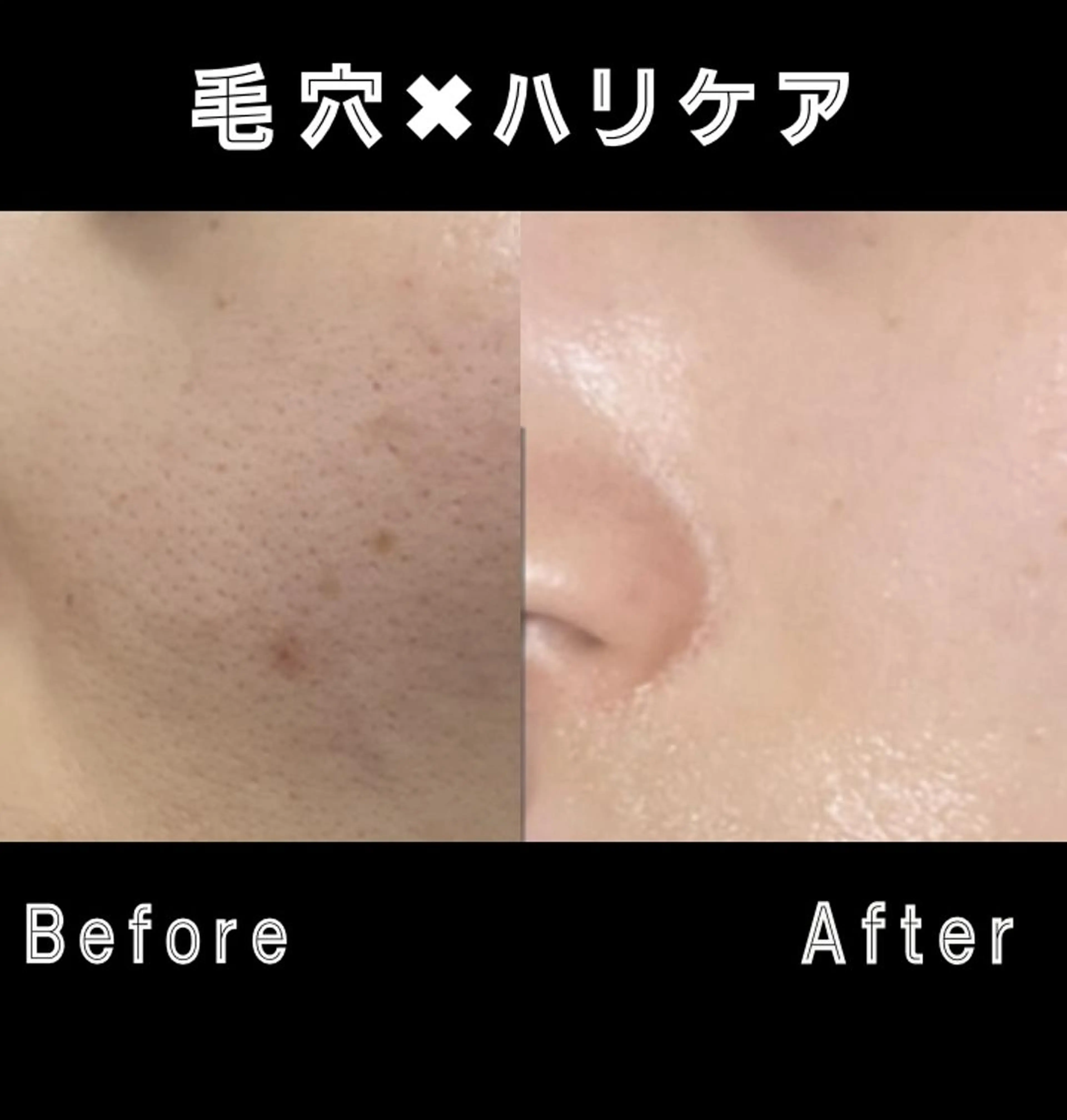 【毛穴・陶器肌】全顔脱毛❣️二段階シェービング付✨光フェイシャルで美白に✨メイク乗りUP❣️の写真