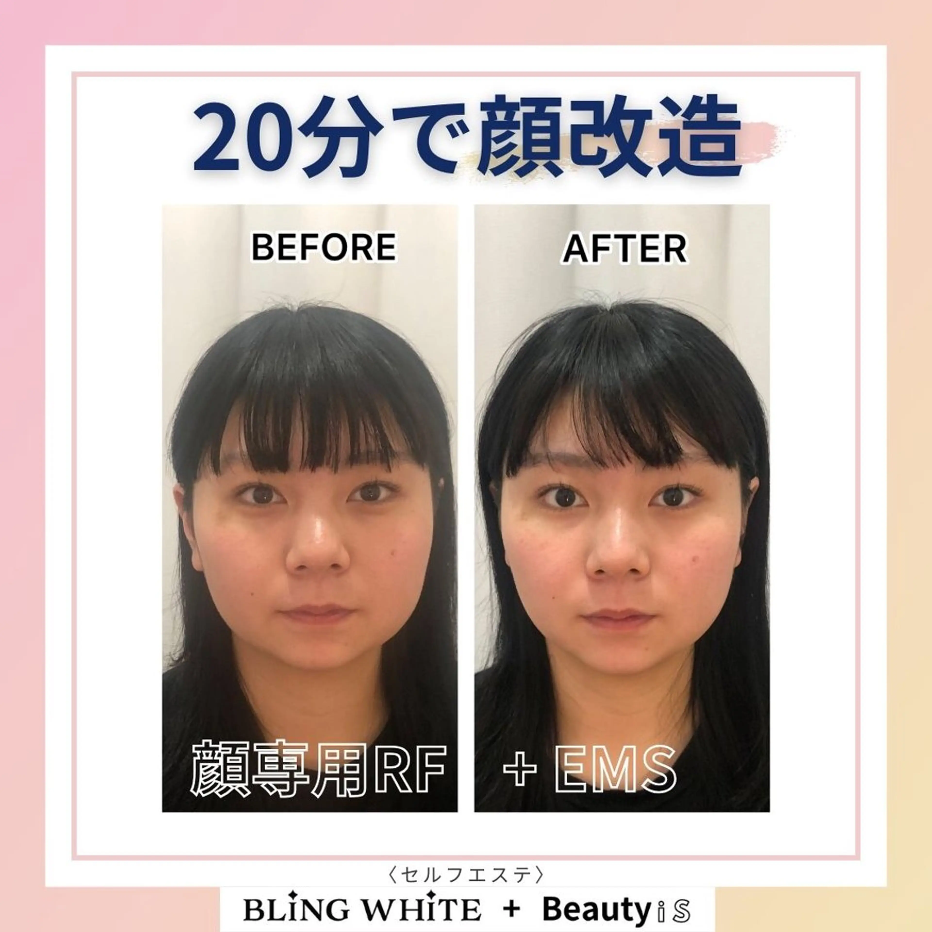 ☆速攻美肌＆リフトUP☆ポレーション美容導入+小顔EMSの写真