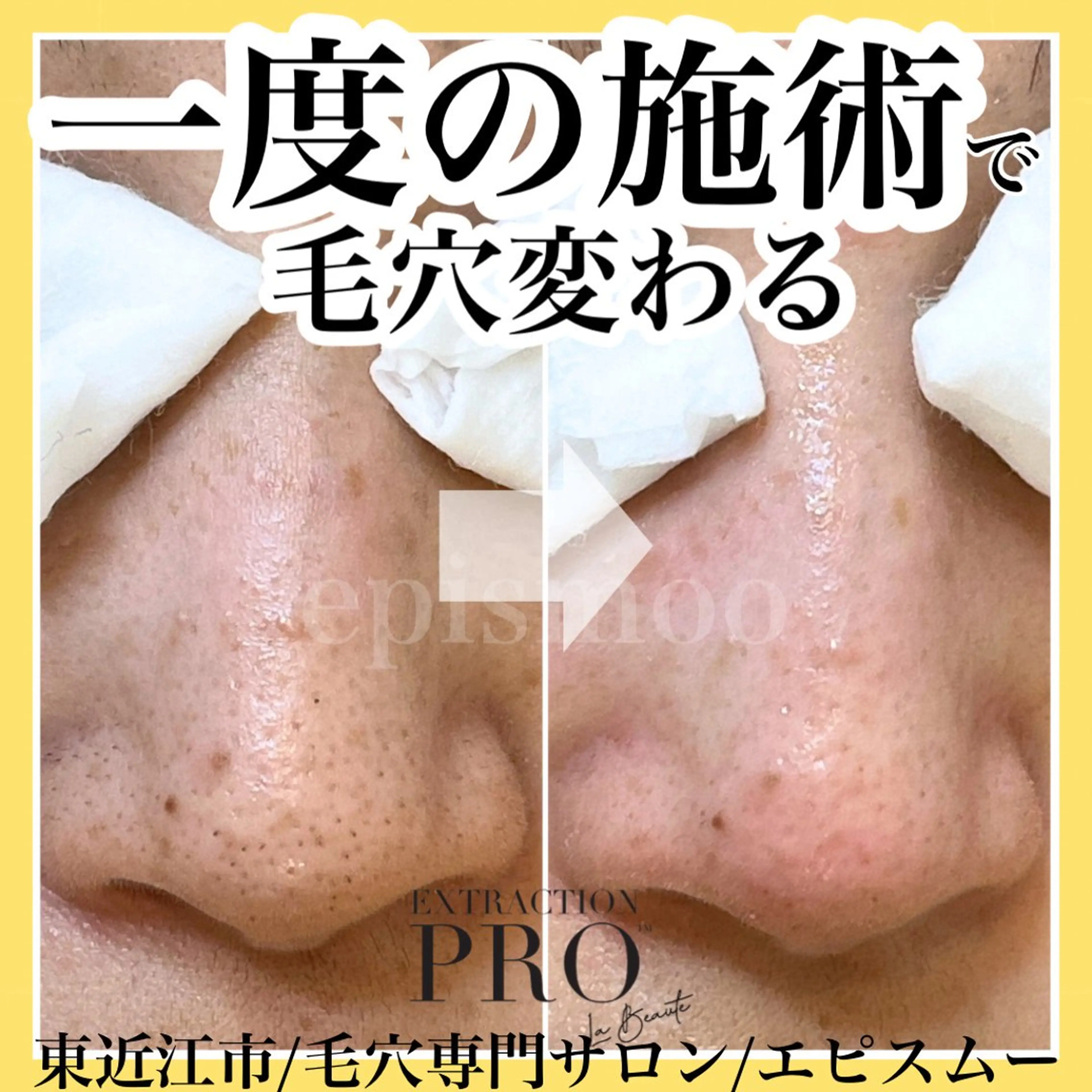 epismoo 脱毛/HBL/毛穴の眉毛・アイブロウイメージ