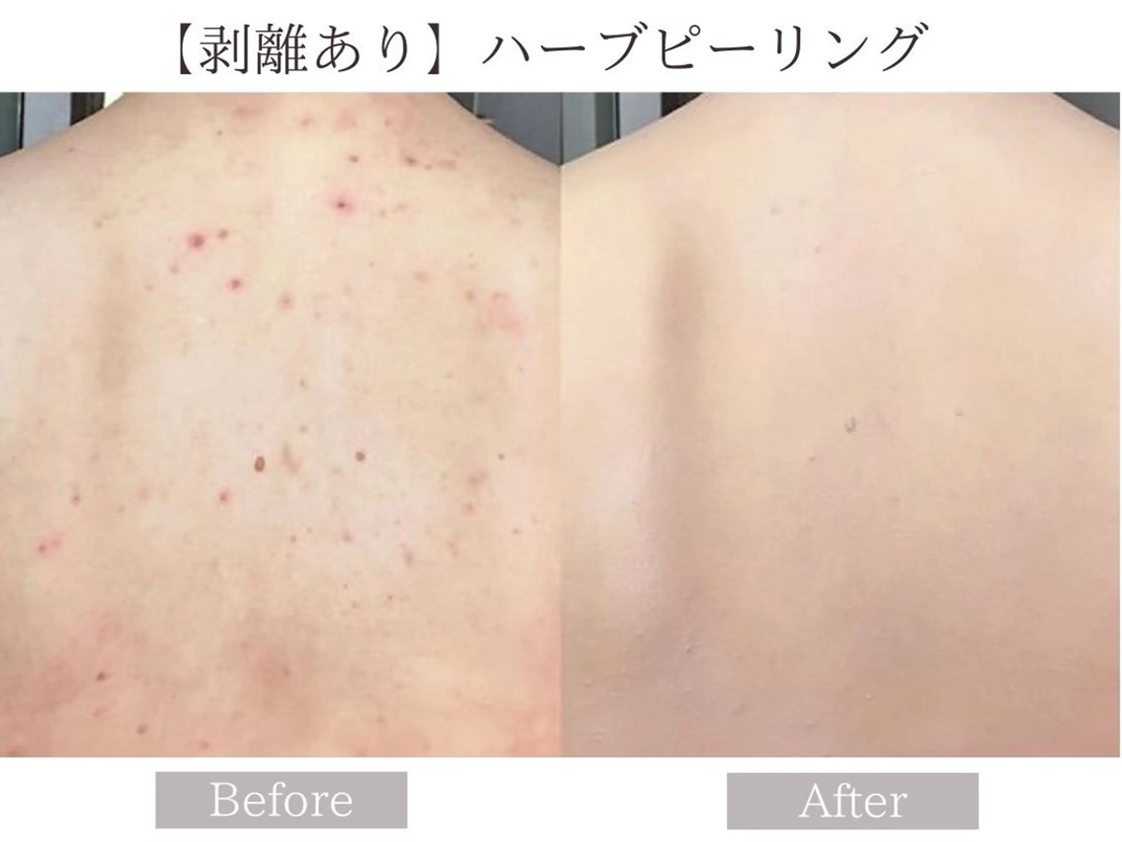 ♦️人気NO,2♦️【剥離ありハーブピーリング•ボディ】〈背中/二の腕/ヒップ/デコルテ対応〉すぐ実感！ハーブピーリングの写真