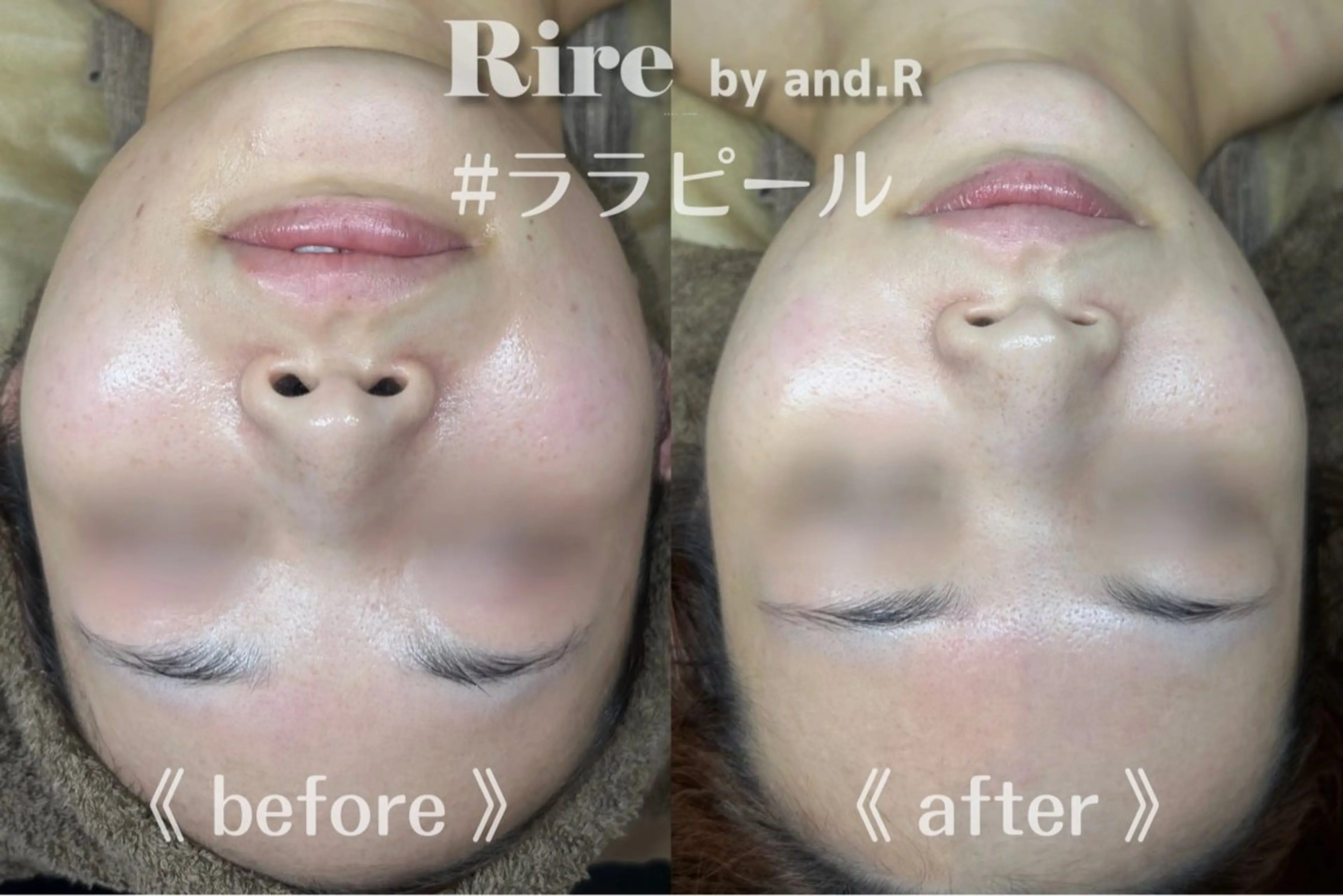 【新規人気】水光肌ララピール(顔＋首＋ヘッド)¥15,000→¥12,000の写真