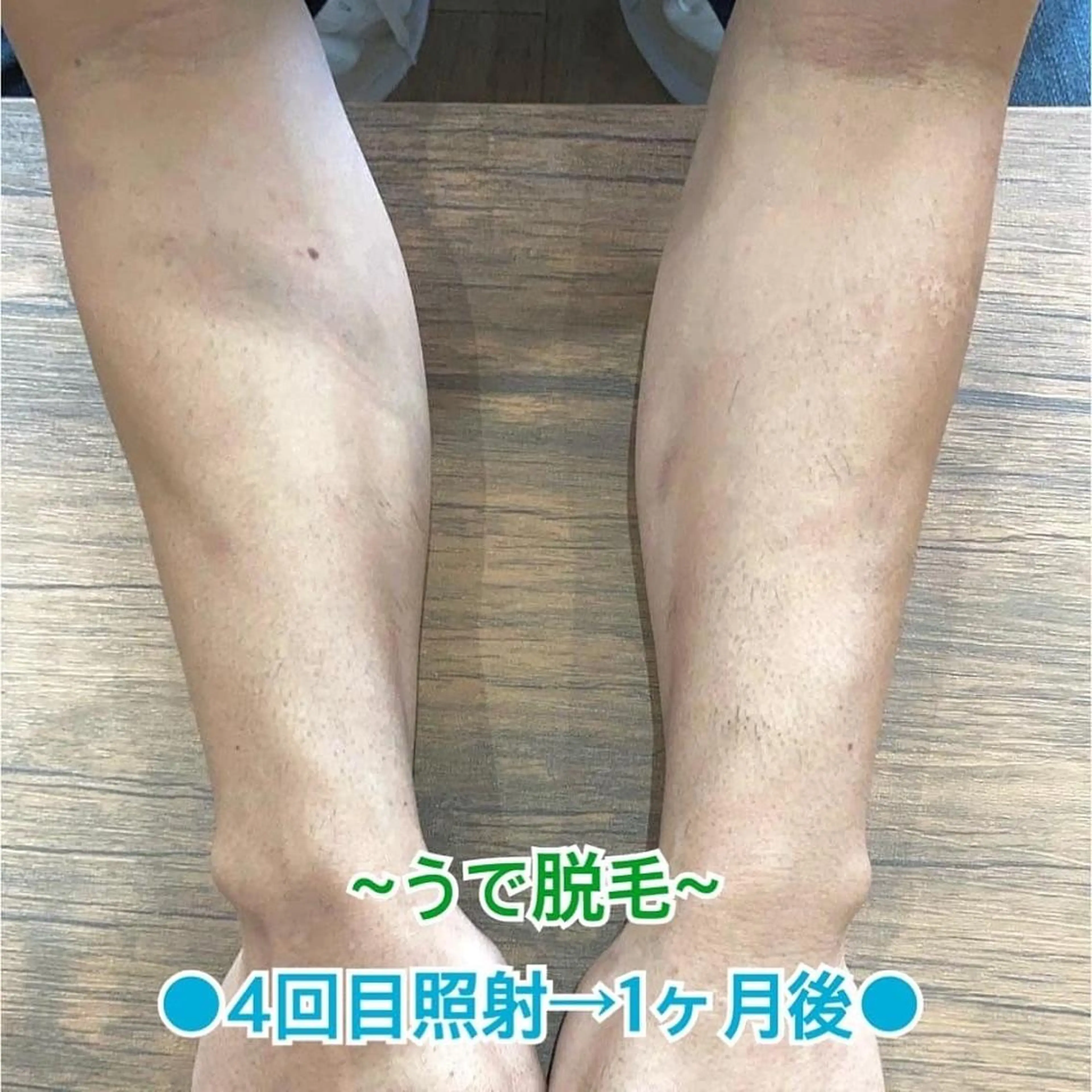 メンズ キッズ 脱毛 BiSTA ヒロのエステ・リラクイメージ