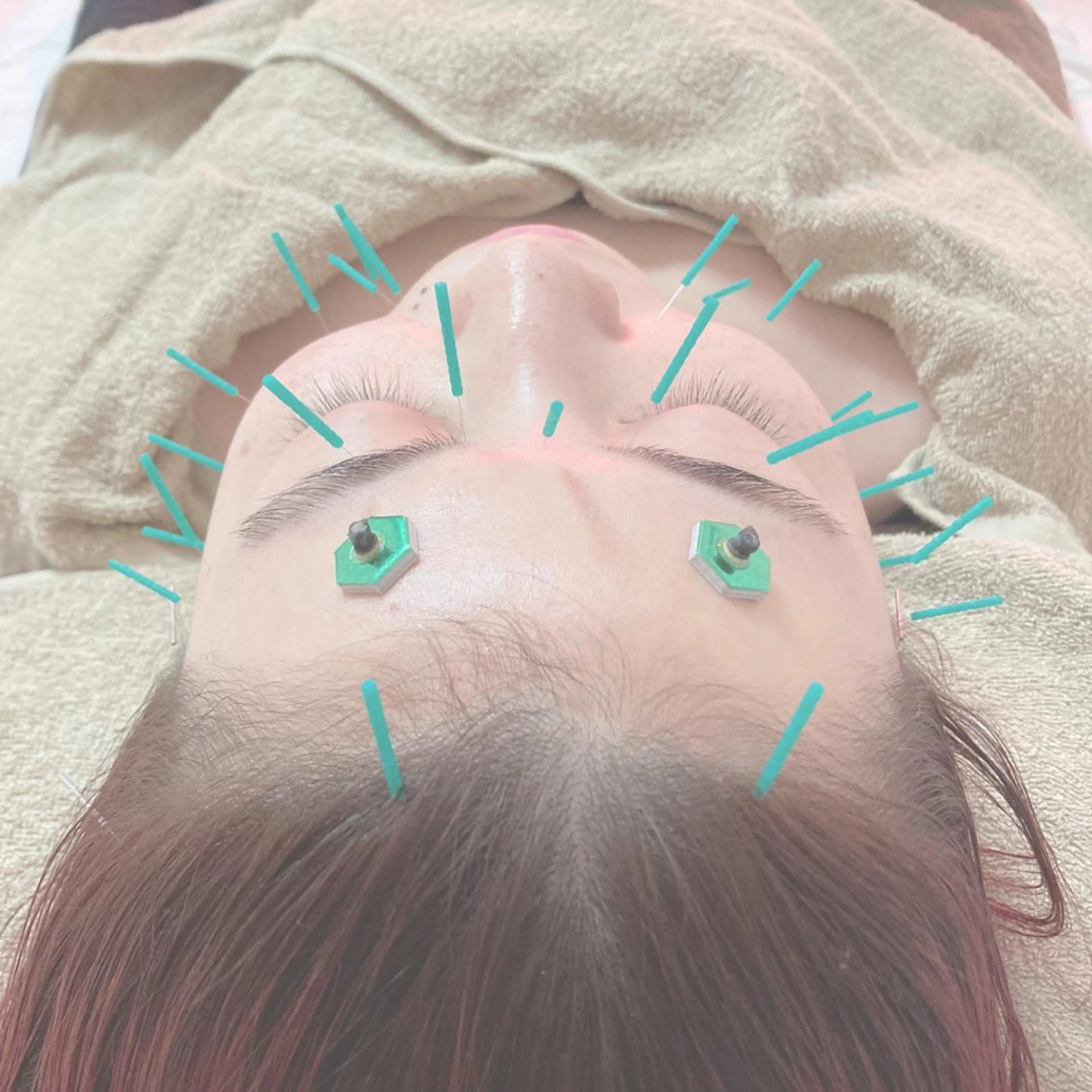 🔰✨お顔スッキリ✨ 美容鍼ノーマルケアコース(お顔のみ)の写真