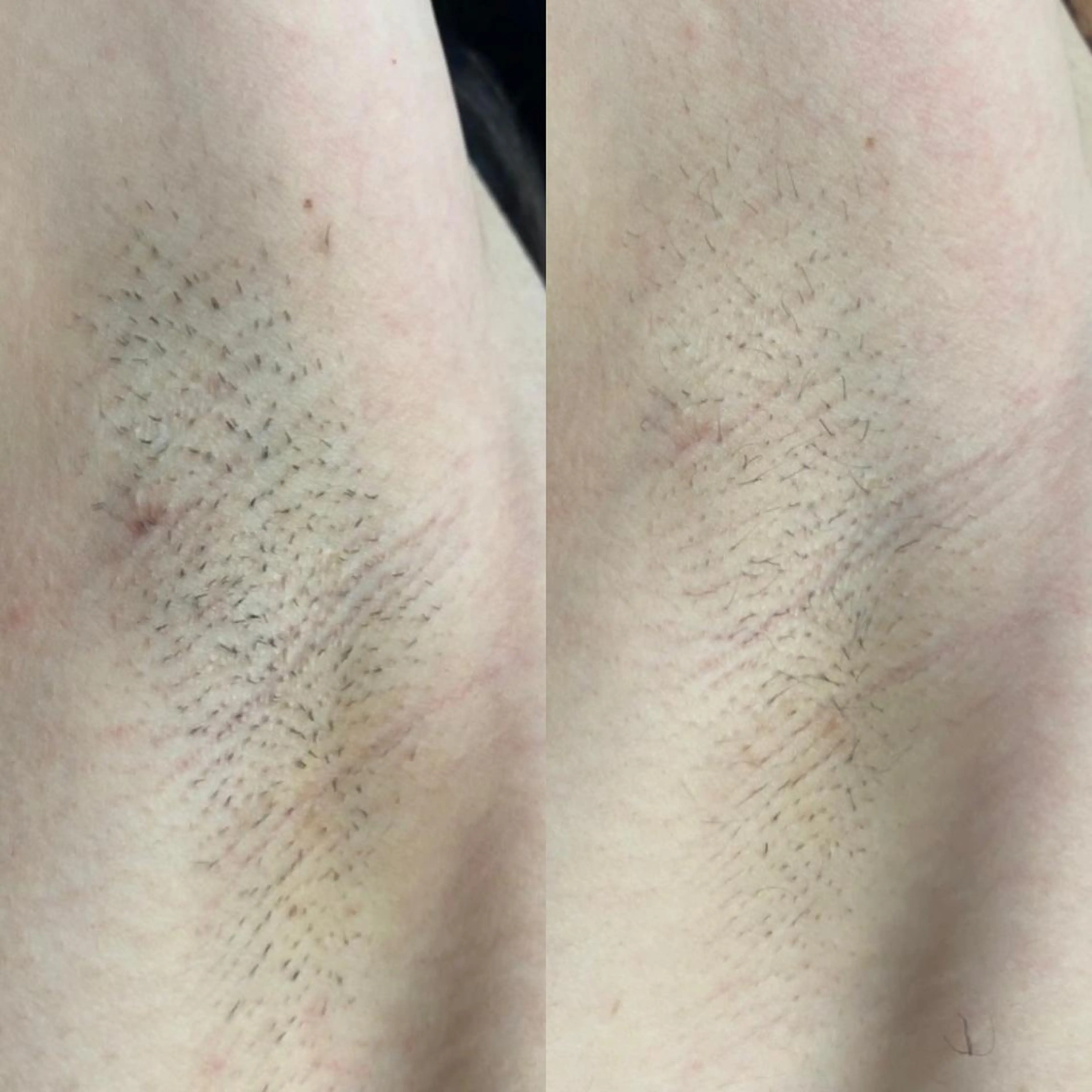 脱毛 シエスタ 山下 上級脱毛士のエステ・リラクイメージ