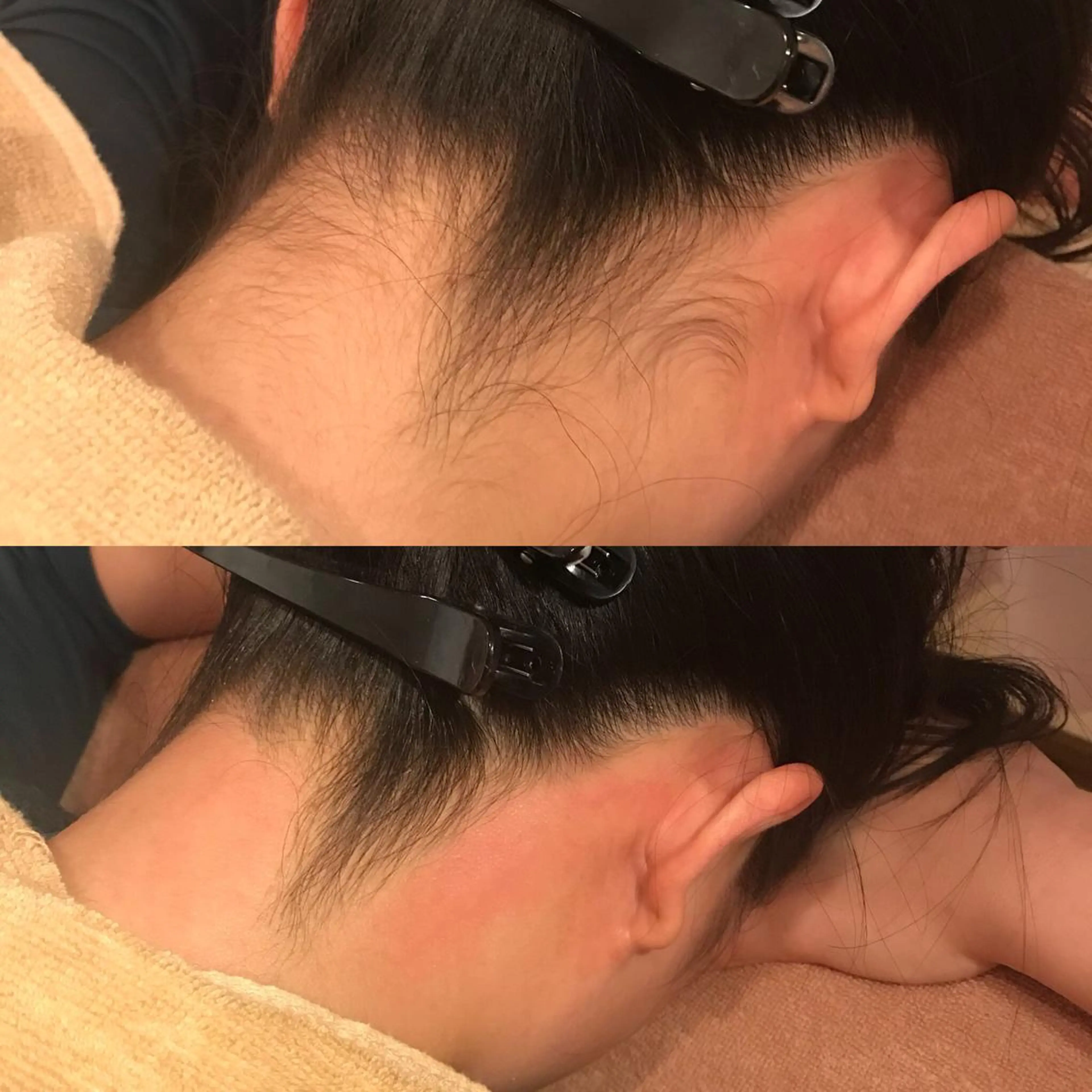 【うなじ美人】ワックス脱毛の写真