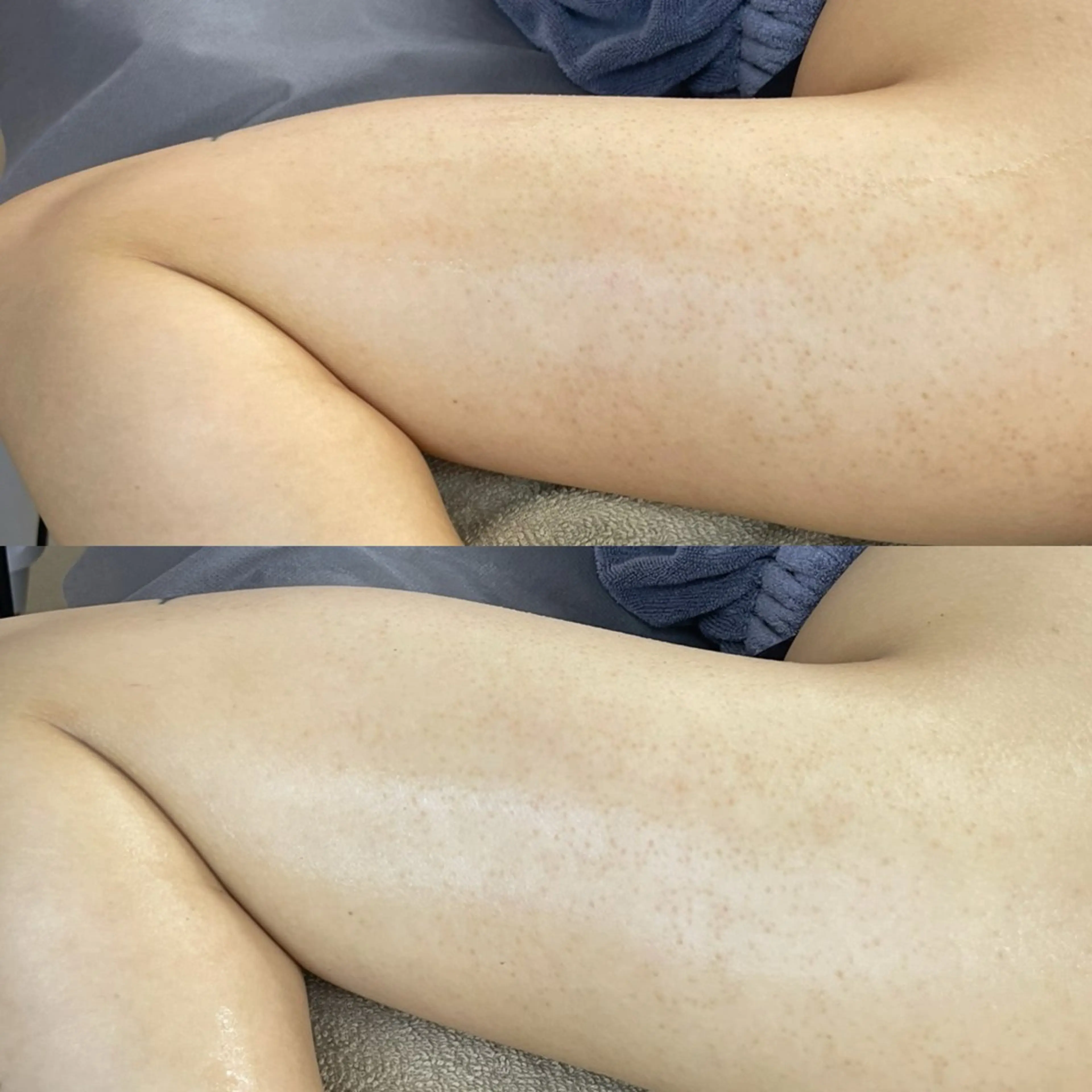 ブライダルに大人気！二の腕のザラつき改善！(メンズ可)の写真