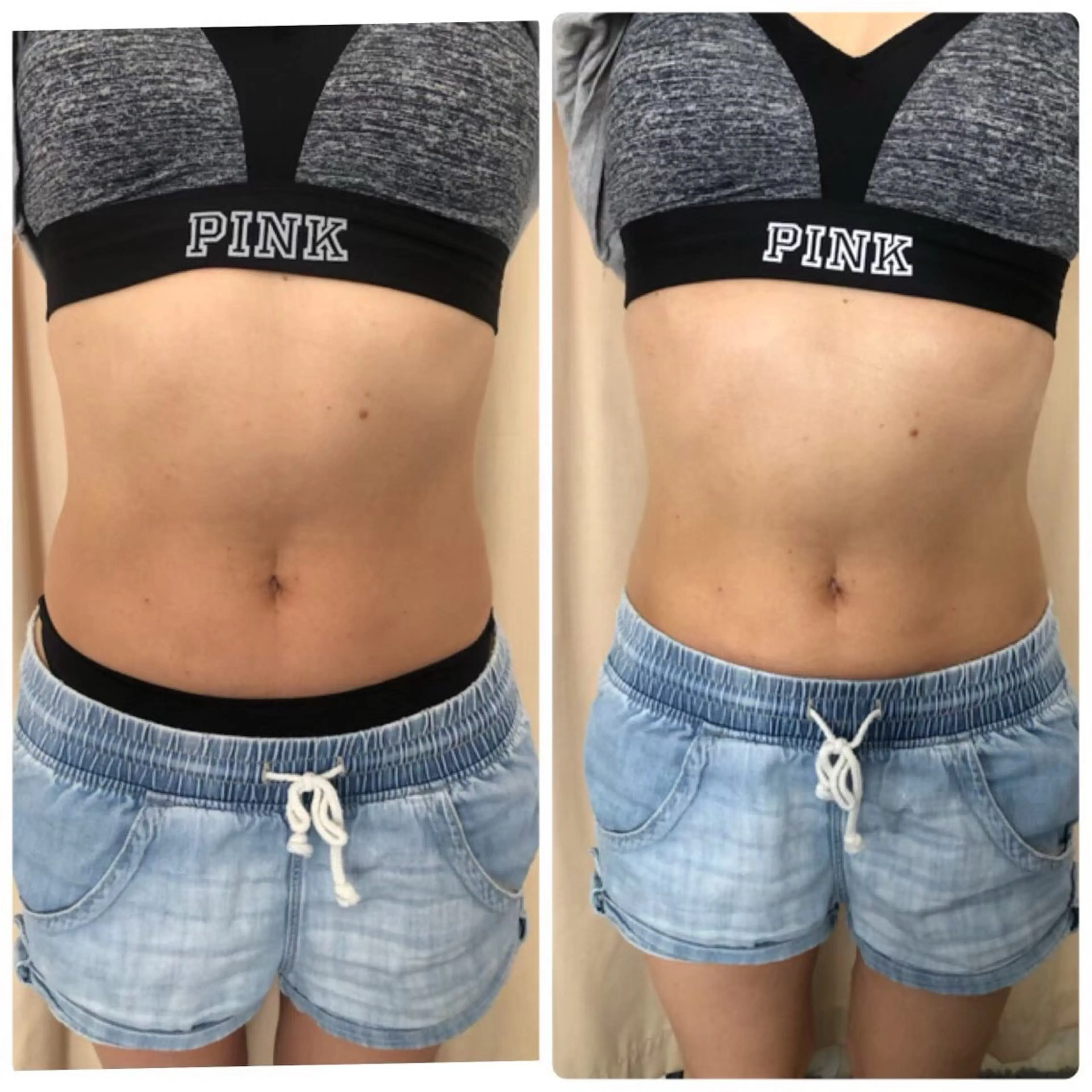 【10月平日限定クーポン🌴】お腹周りのお肉撃退！セルライト除去。の写真