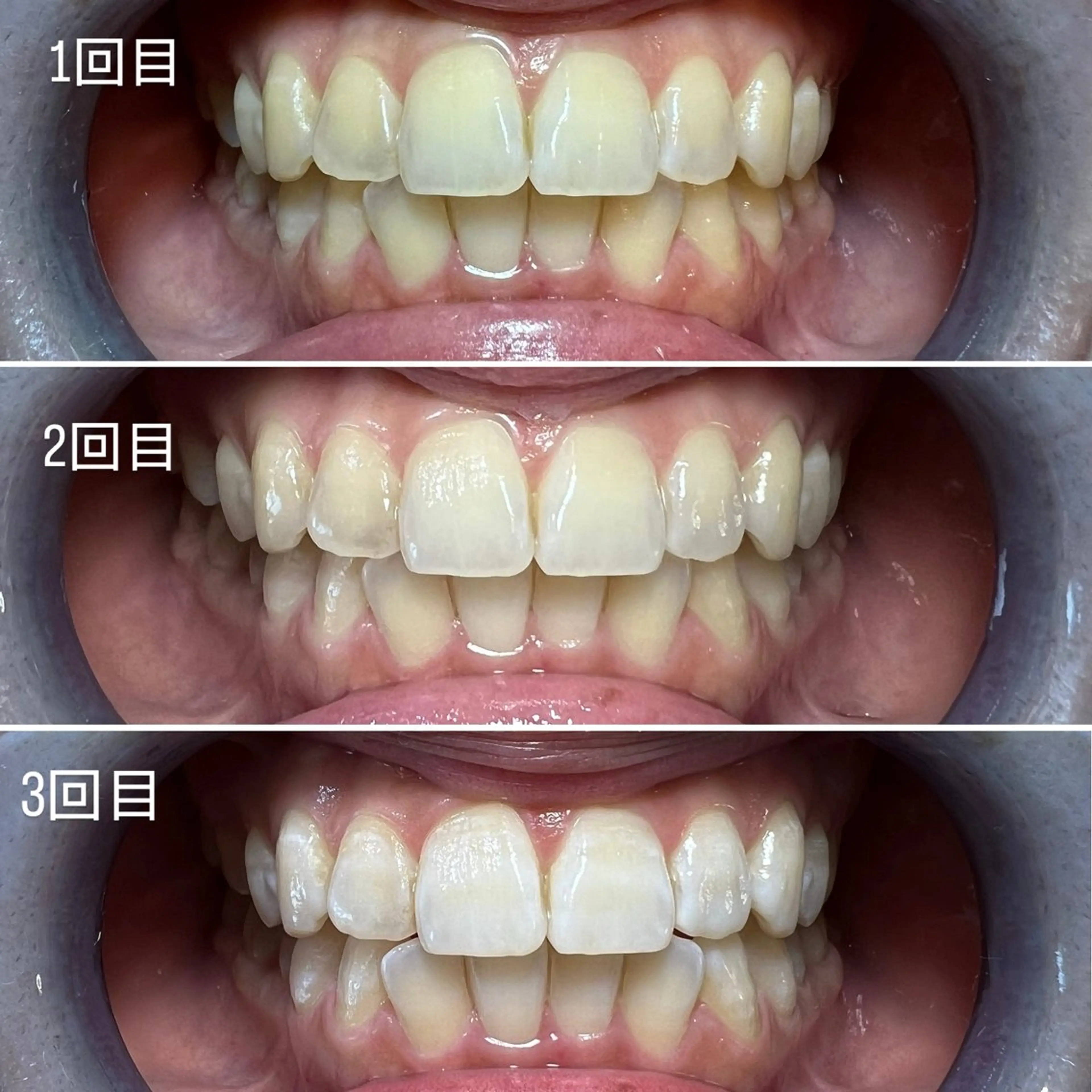 セルフホワイトニング Shineeのエステ・リラクイメージ