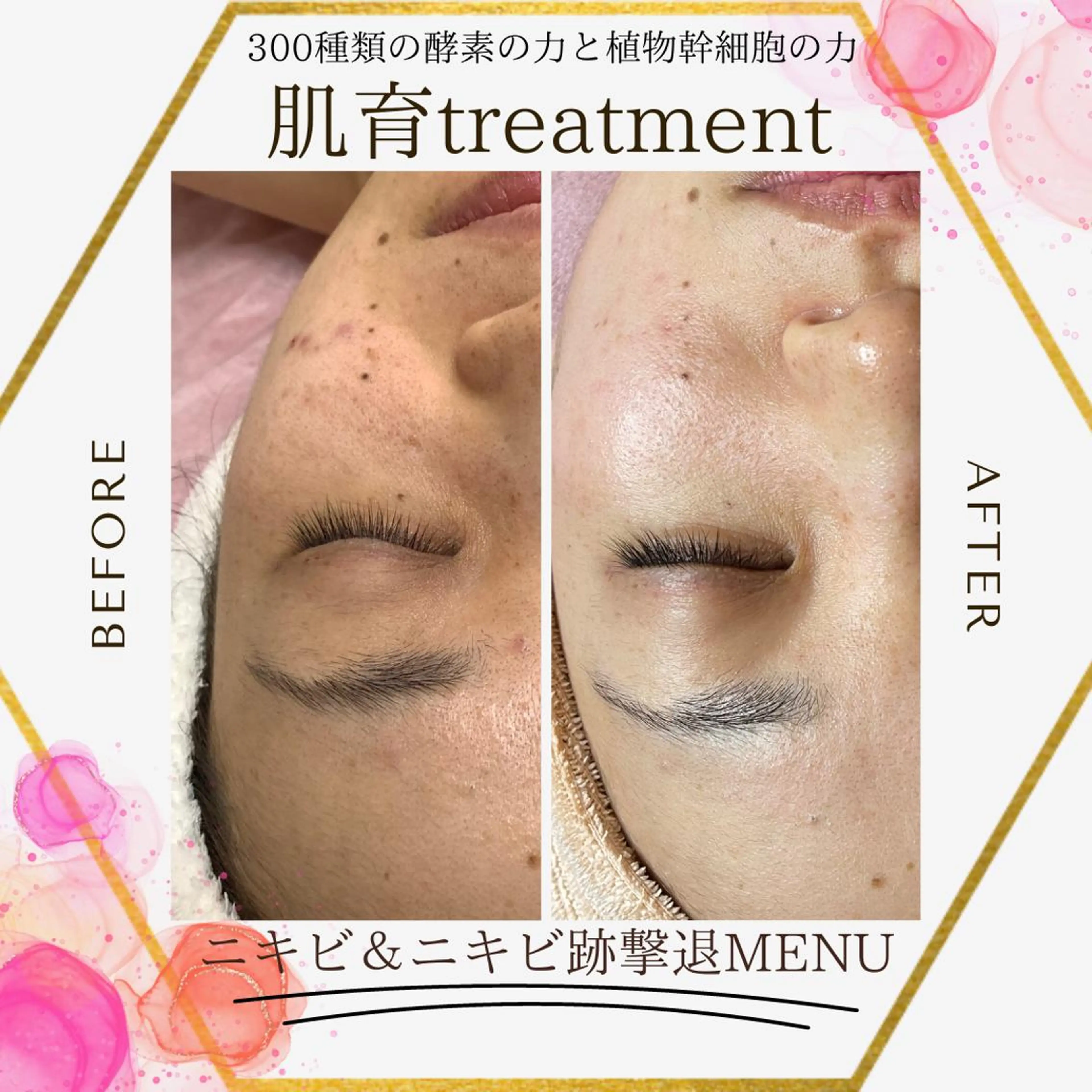 陶肌トリートメント小顔　美白コース💎の写真