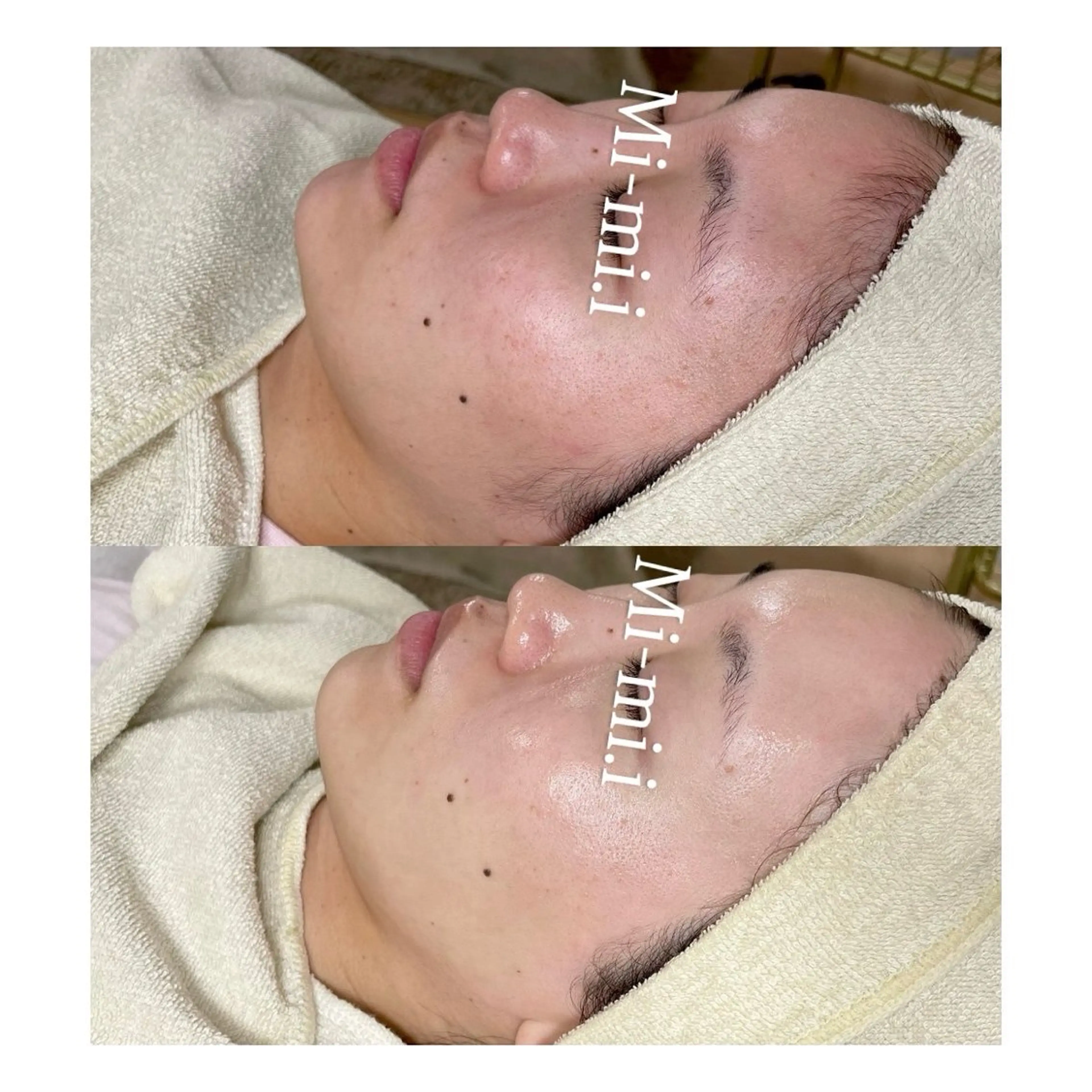 【艶肌WAX】毛穴、産毛、角質、顔ダニさようなら🫶🏻艶肌フェイシャルワックス脱毛♡産毛が無くなる=毛穴が無くなる！の写真