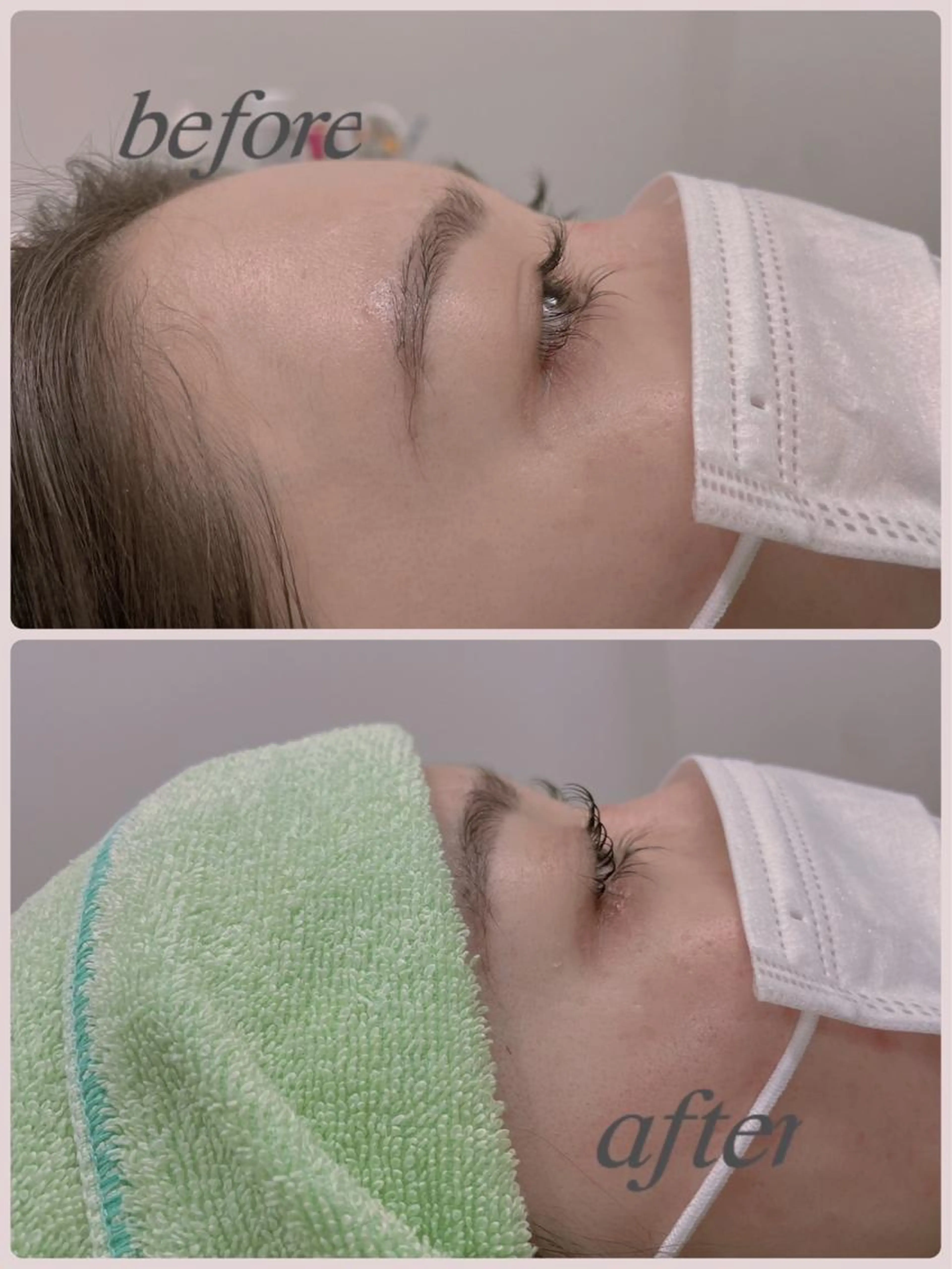 フェイシャルシェービング(お顔剃り)の写真