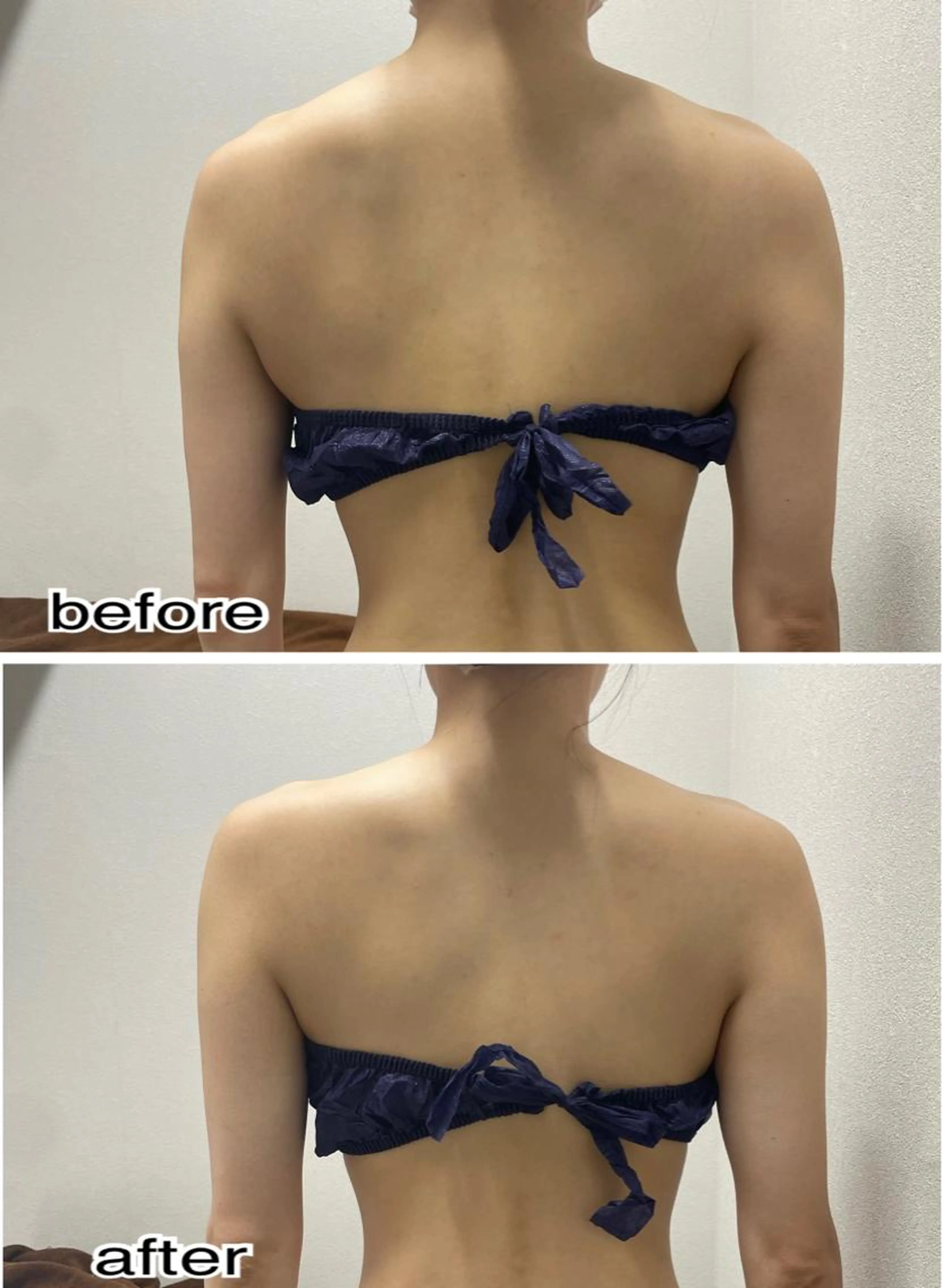 👤肩こりをスッキリ👤3D超音波リフト4000shot!!レディースメンズok👌❤️の写真