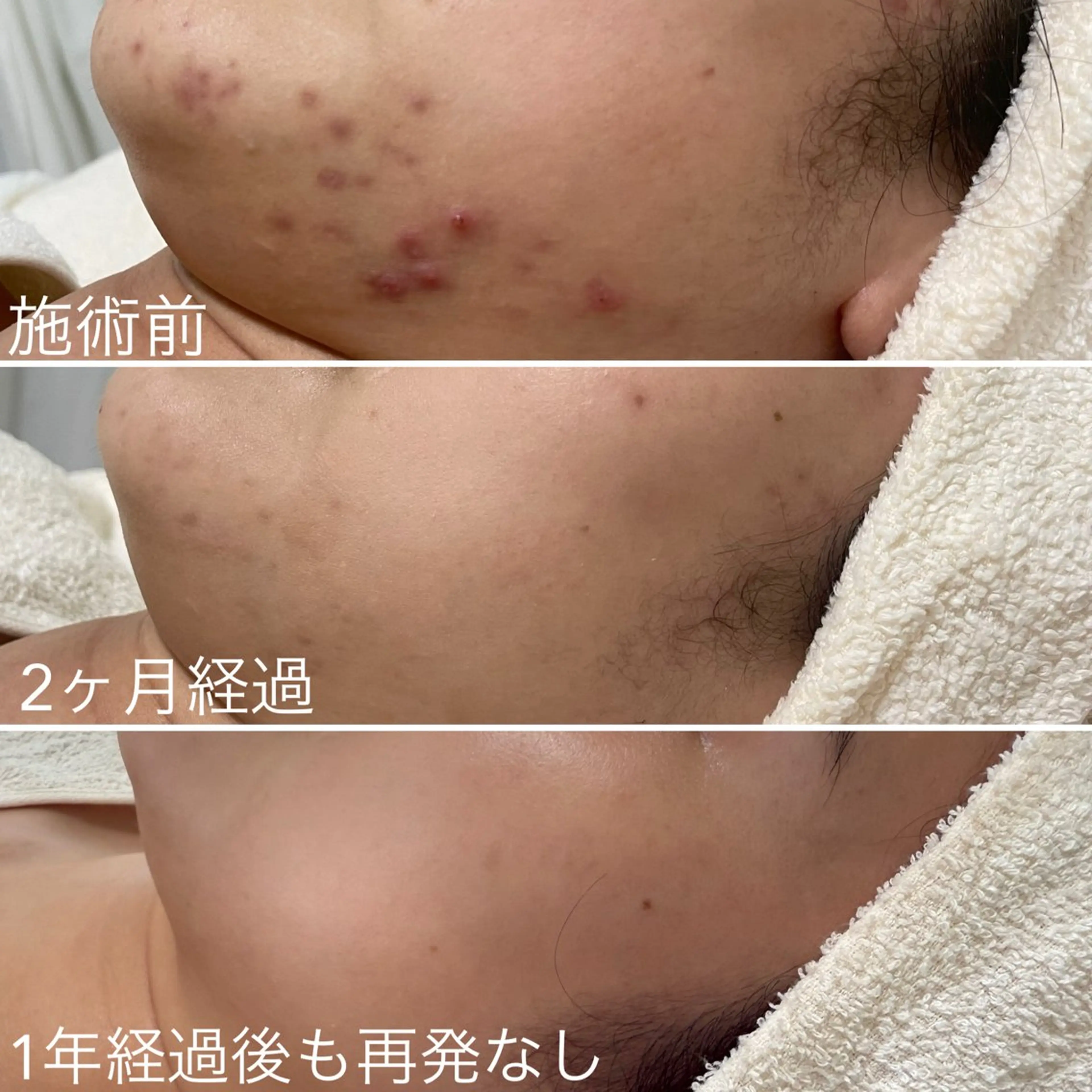 シェノン所属・ニキビ・毛穴・ フェイシャル専門店のエステ・リラクイメージ