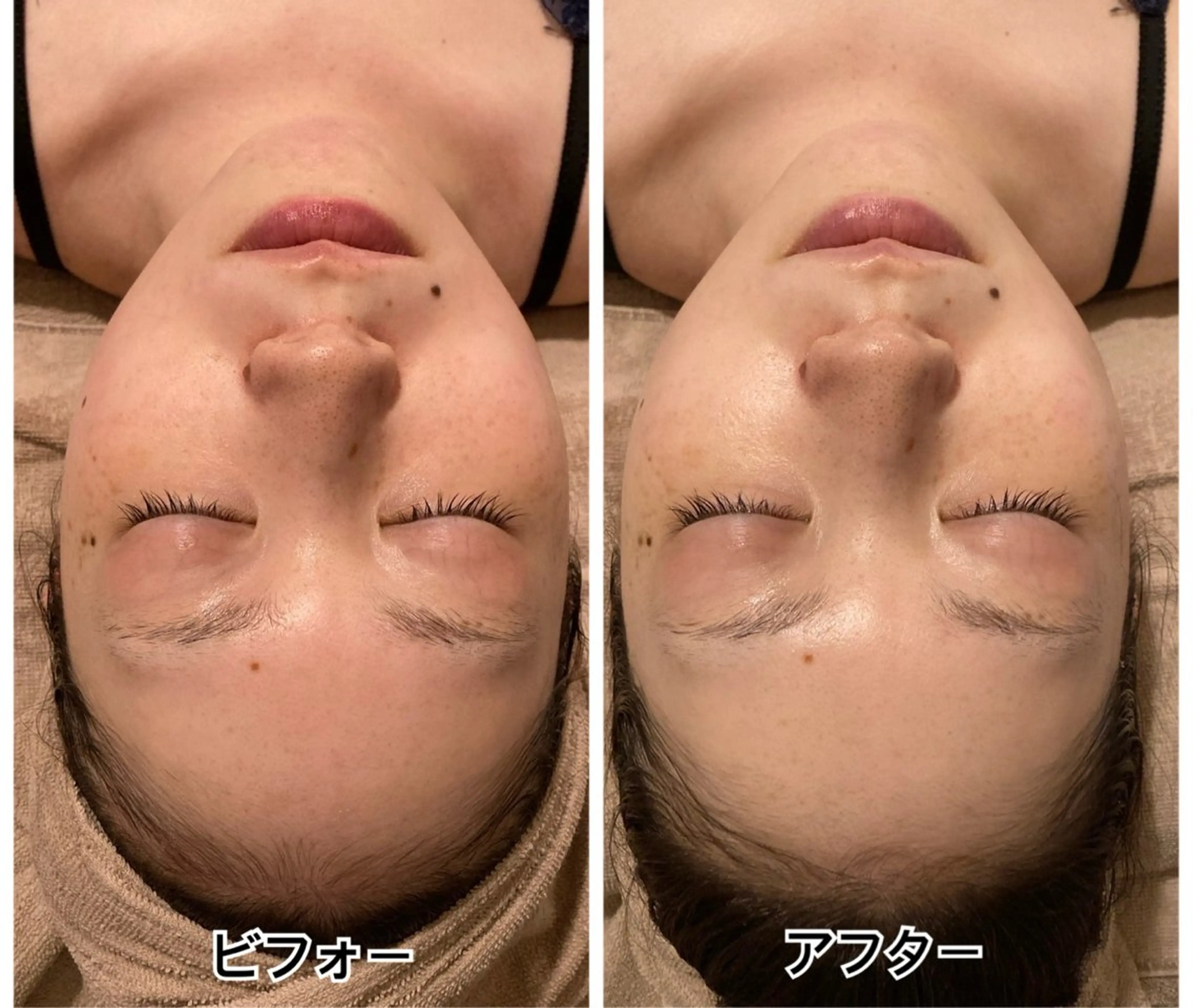 リフトアップやエイジングケアに💜【 ラミネーションピール＋美容鍼80分🫧 】ハイドロジェリーマスクでしっかり保湿✨の写真