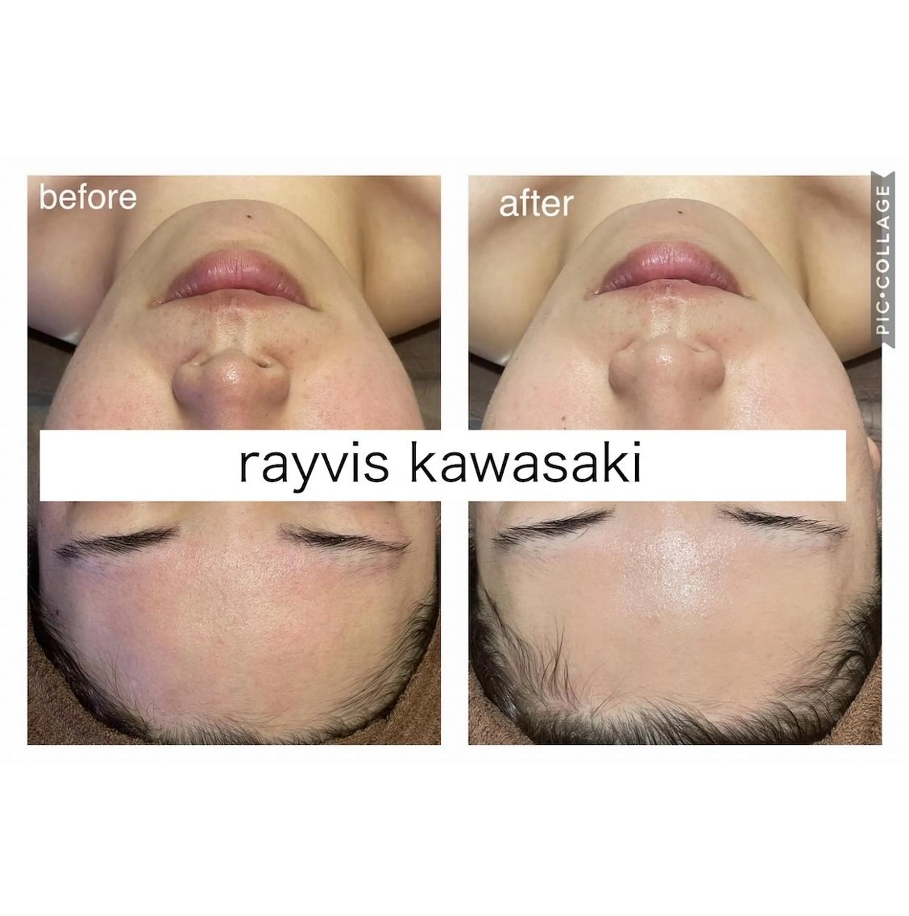 24歳以下限定🌸新生活応援!!白玉ピーリングで垢抜け透明感✨毛穴・美白フェイシャル体験￥1980の写真