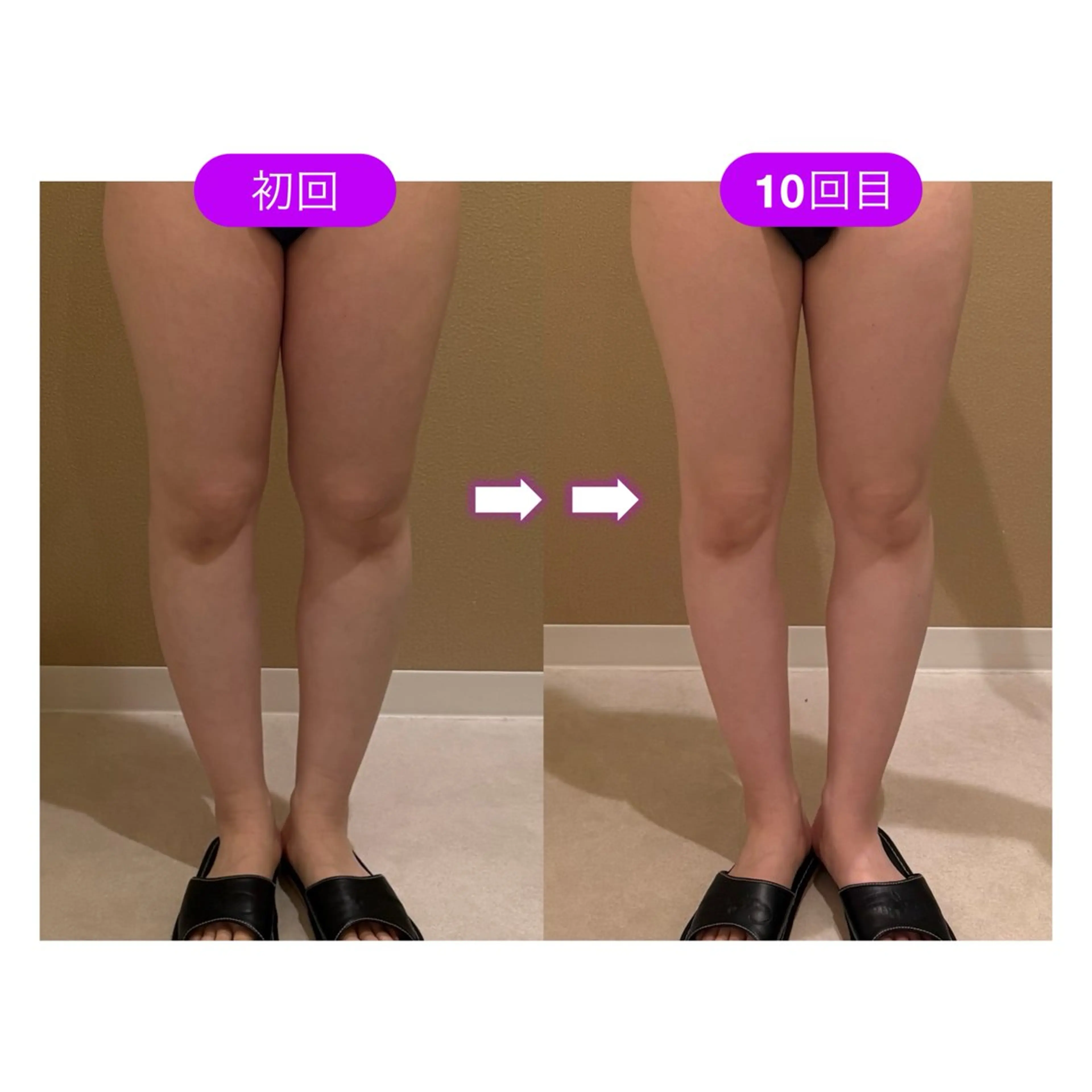 🉐4月限定🉐【痩身60分16500円】(ハイパーナイフEX)❸回チケット🎫🎫🎫¥49500→¥32000の写真