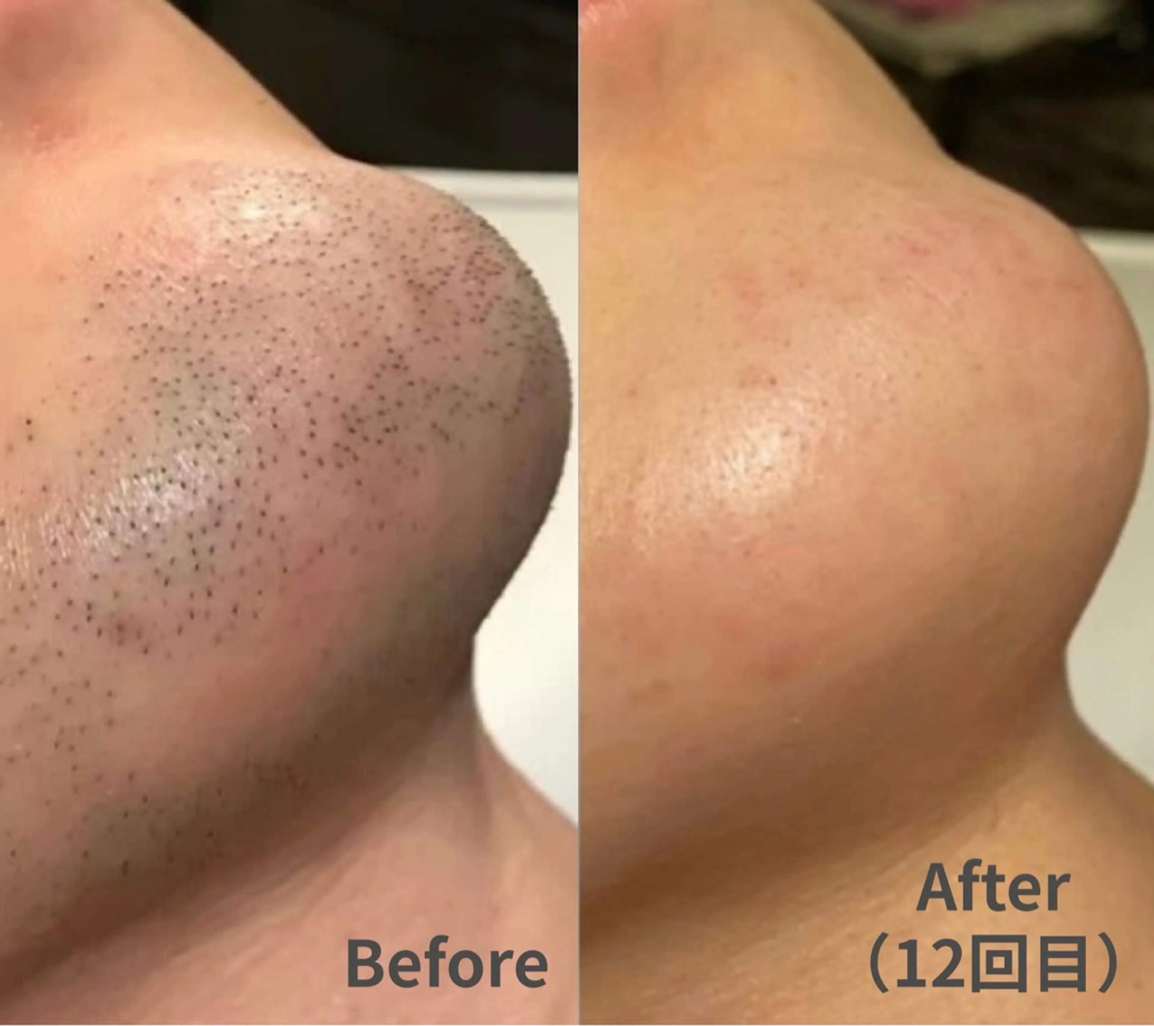 【男性人気No.1】効果重視！ヒゲ脱毛 ￥3,000の写真