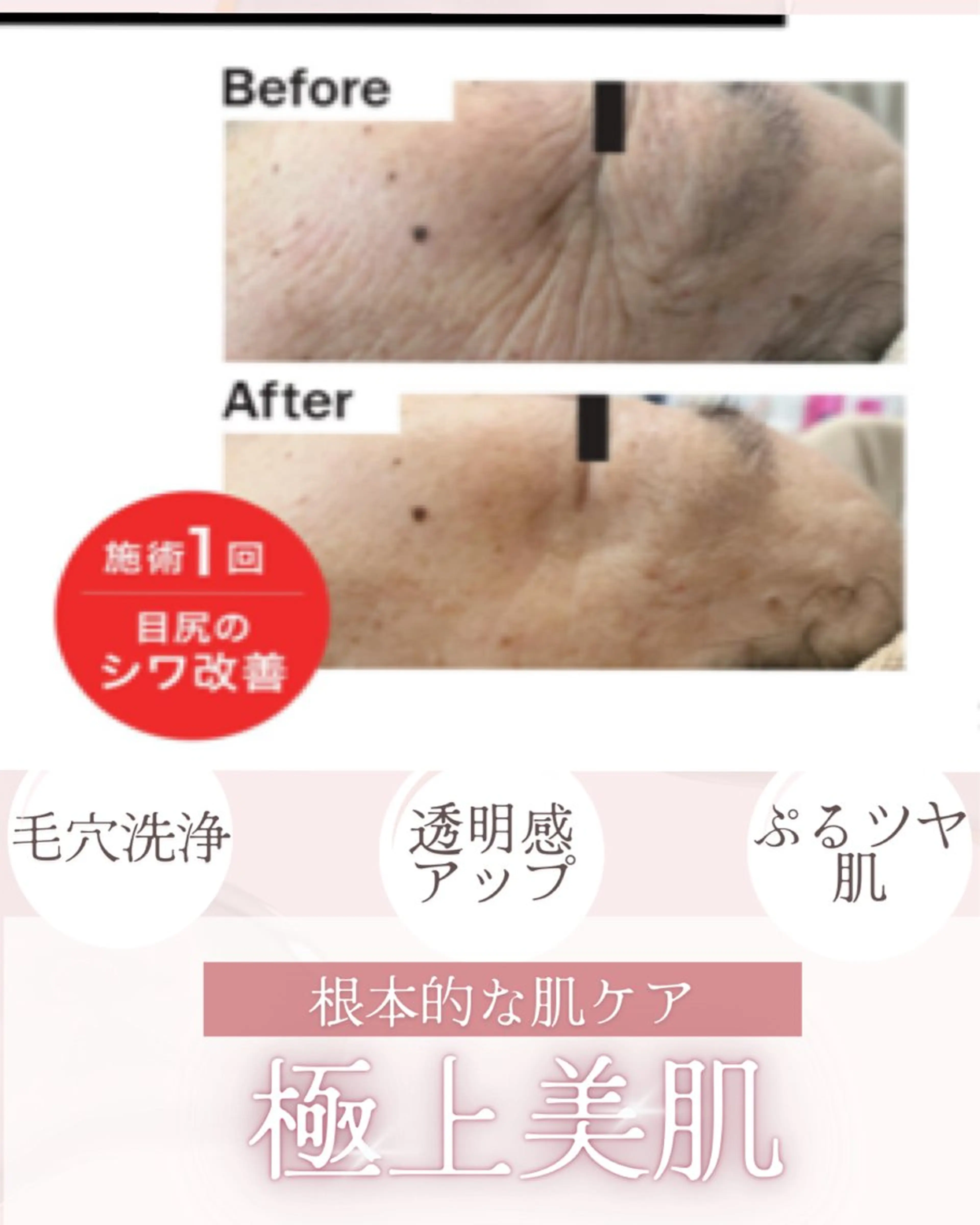 【短期集中】シワやたるみでお悩みの方必見！クリニックで使用のポレーションで高濃度幹細胞を導入！毛穴洗浄の写真