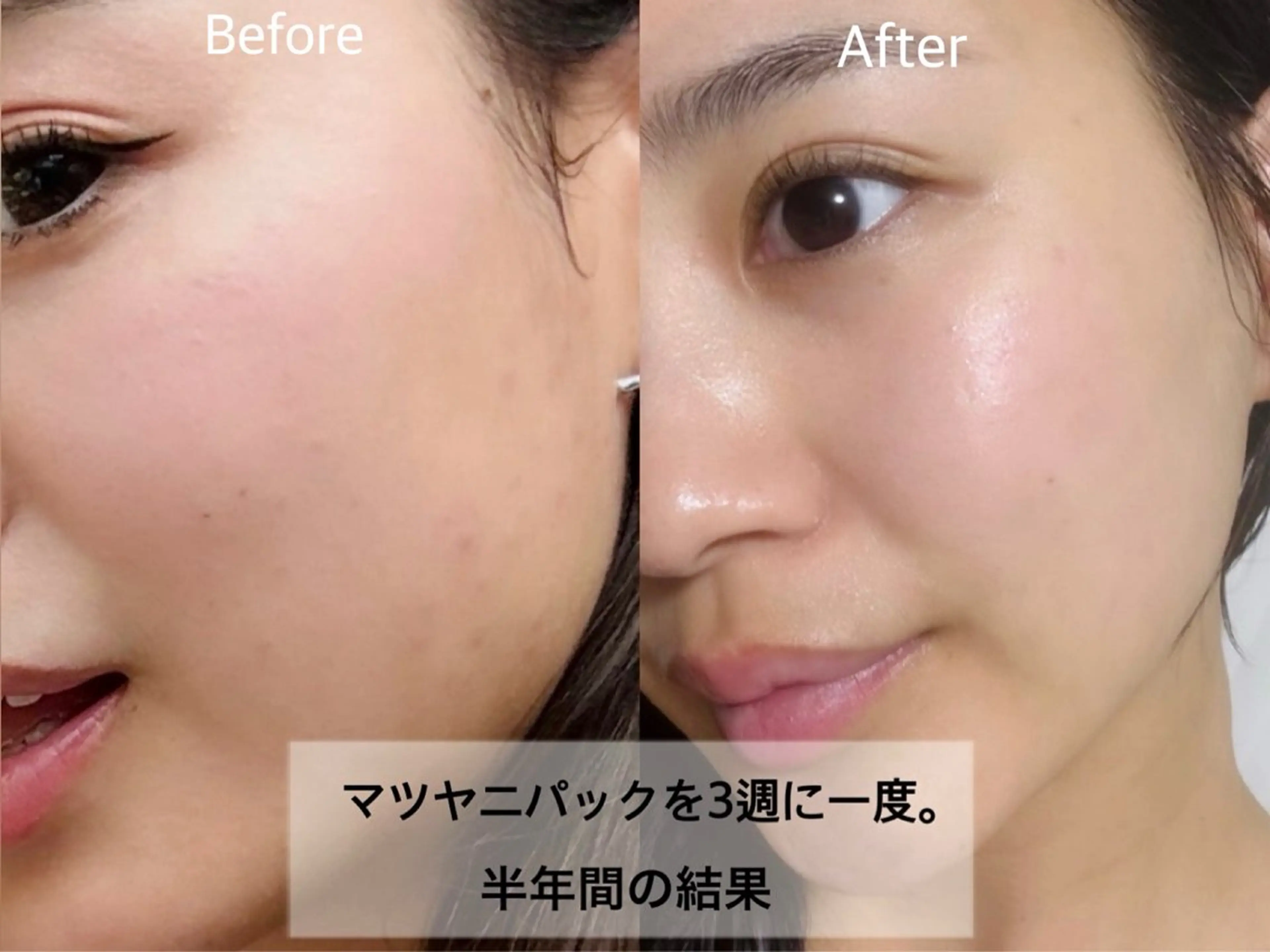 beauty salon Fee所属・毛穴開き黒ずみ ニキビ特化💆♀️のエステ・リラクイメージ