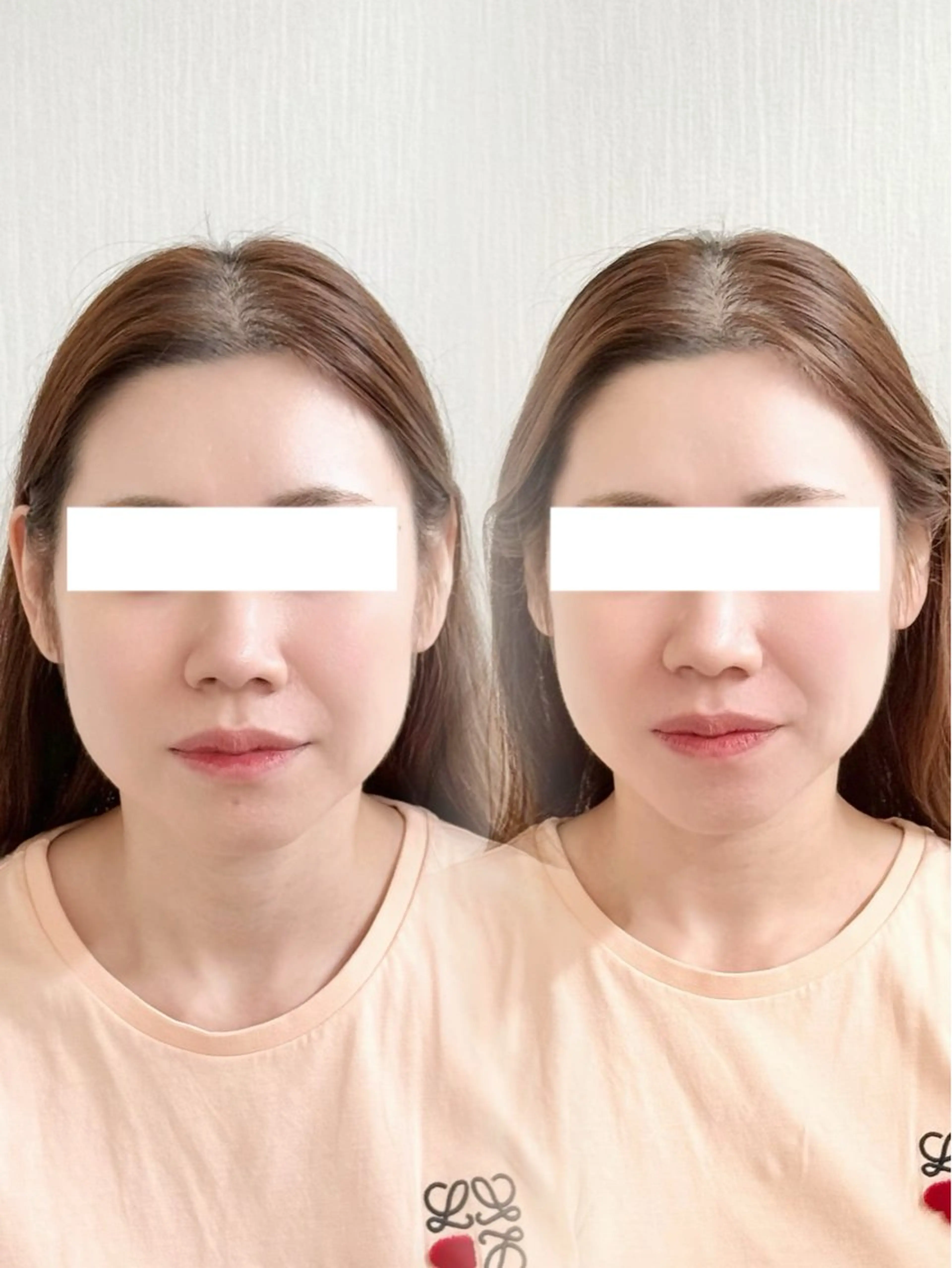 小顔フェイシャルエステ/ 小顔矯正の写真