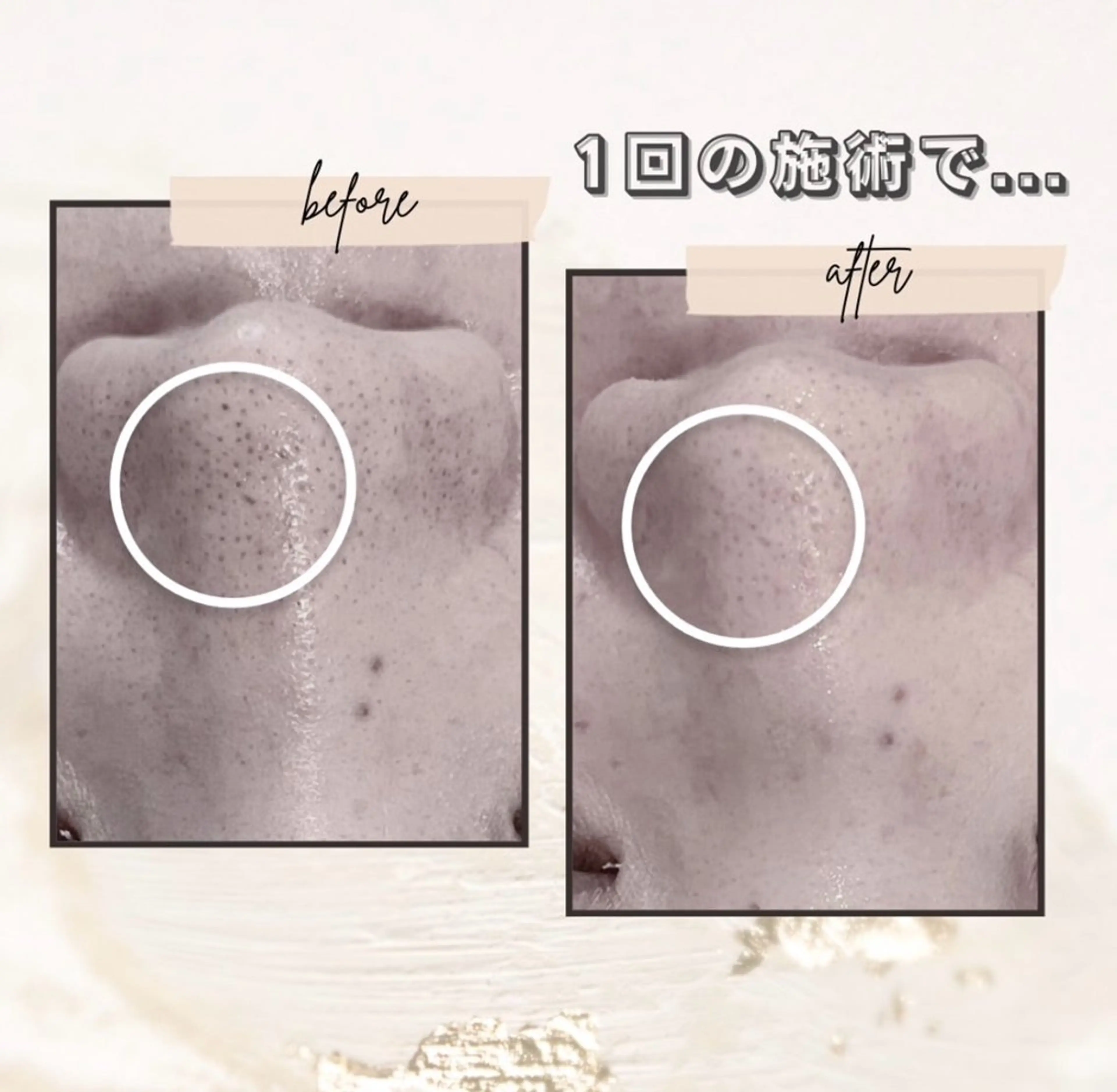 【モニター限定】鼻周りのみの集中毛穴洗浄☆施術前後の写真・動画撮影・ネット掲載OK・口コミの記入をして下さる方のみ。の写真