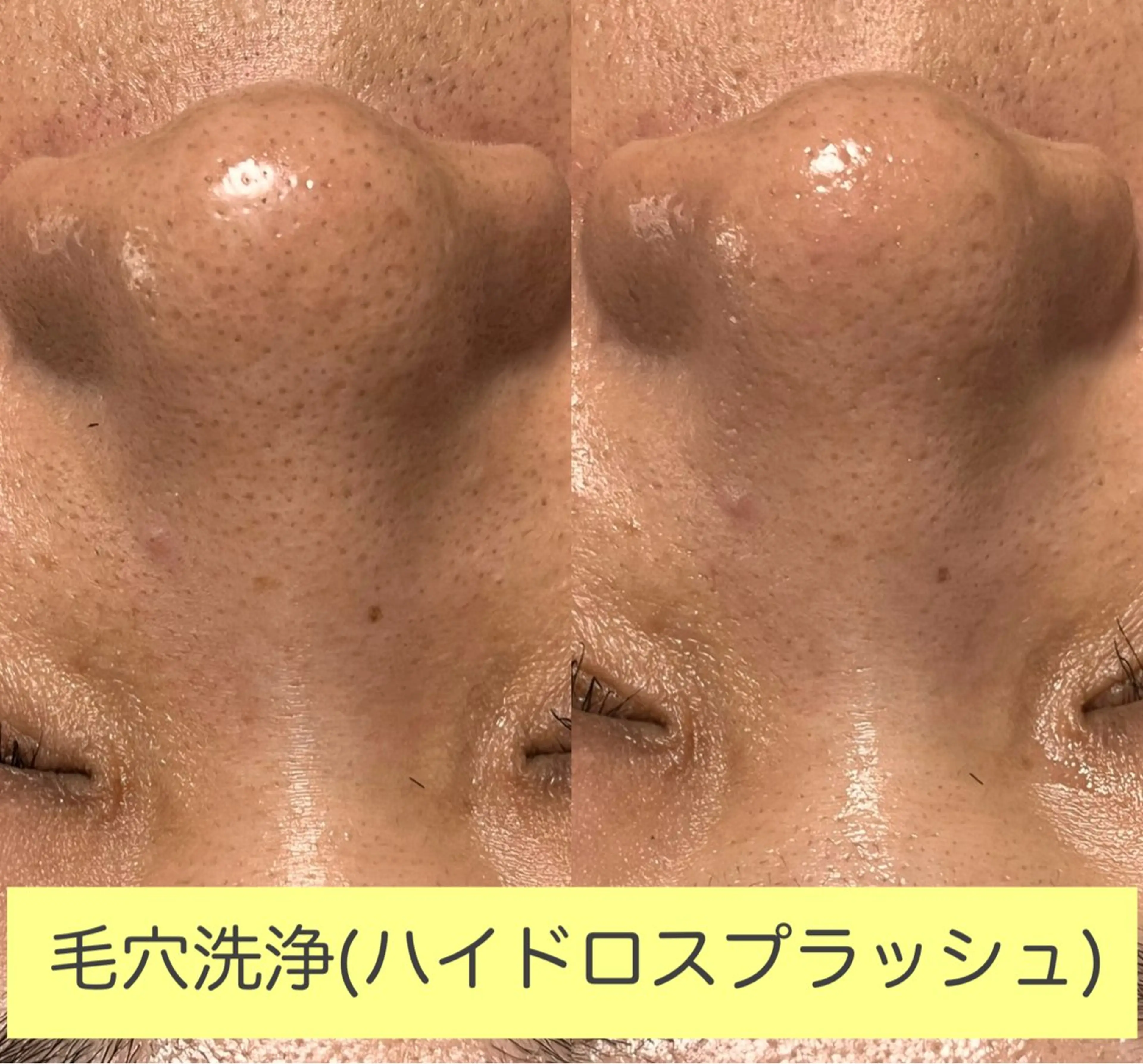 エステ 毛穴洗浄🍀脱毛🍀 光フェイシャル🍀のエステ・リラクイメージ