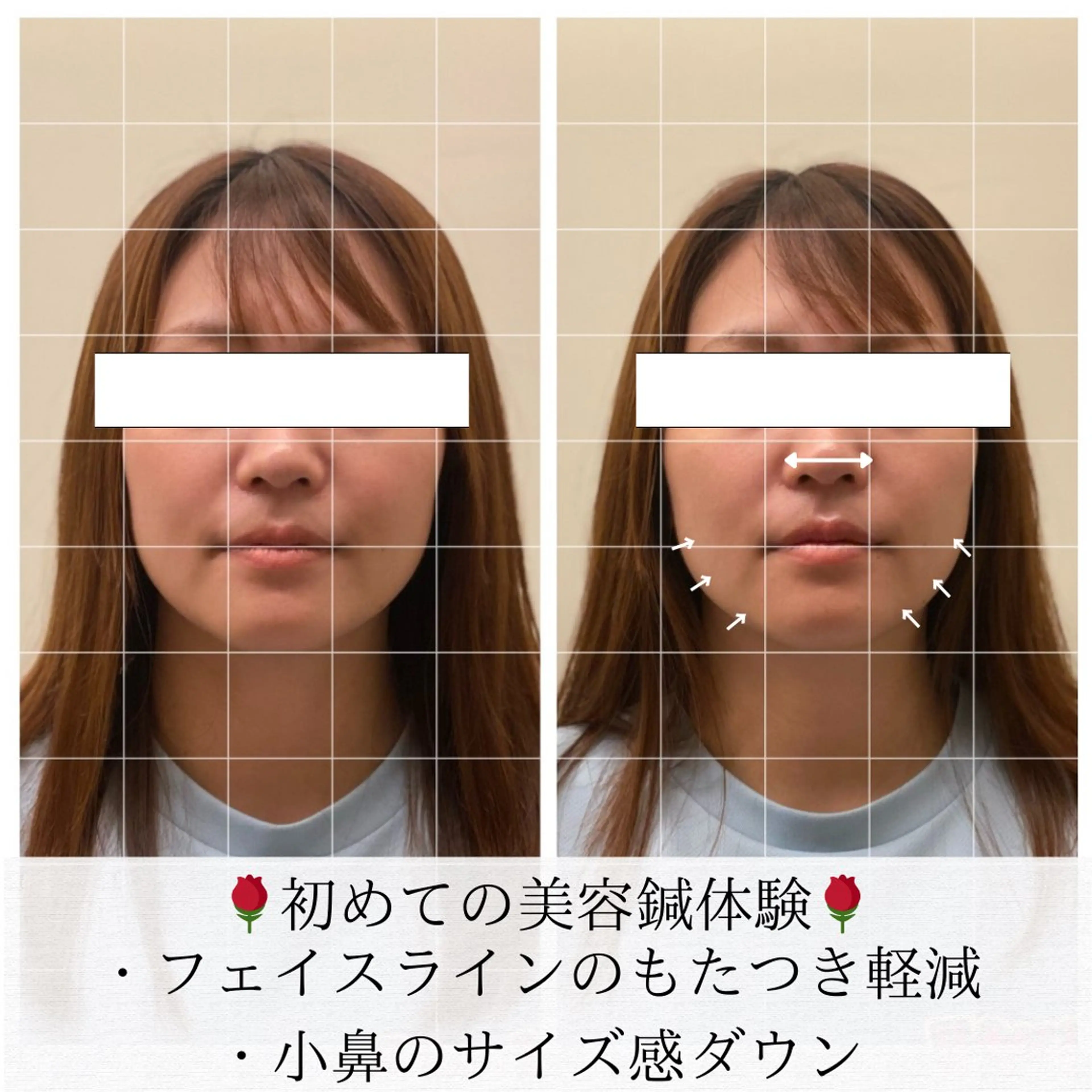 美容鍼/ヘッドスパ/ 💎さかもとのエステ・リラクイメージ