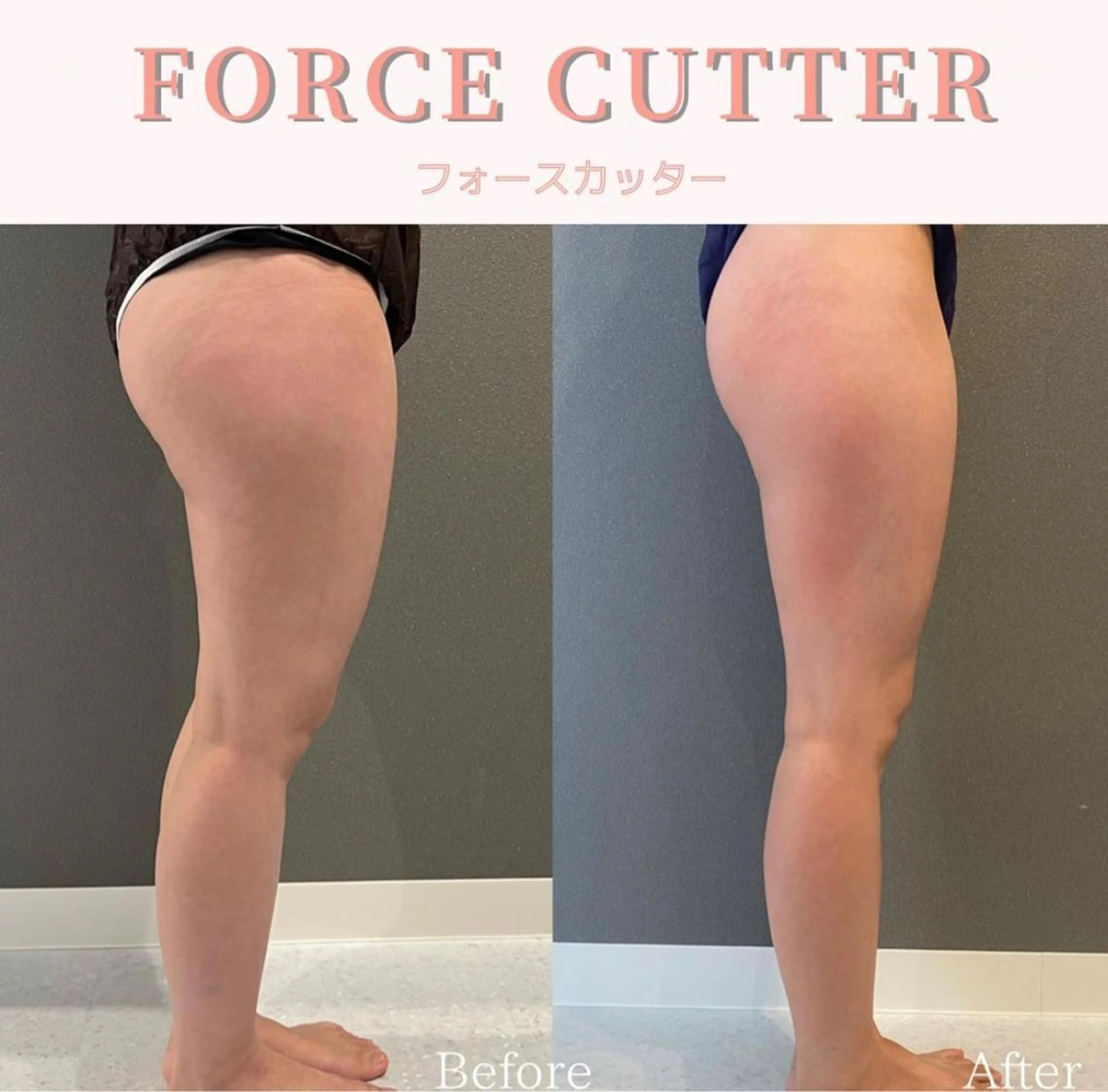 【ボディ】1台で4役の痩身効果◎美ボディマシン(1部位)の写真