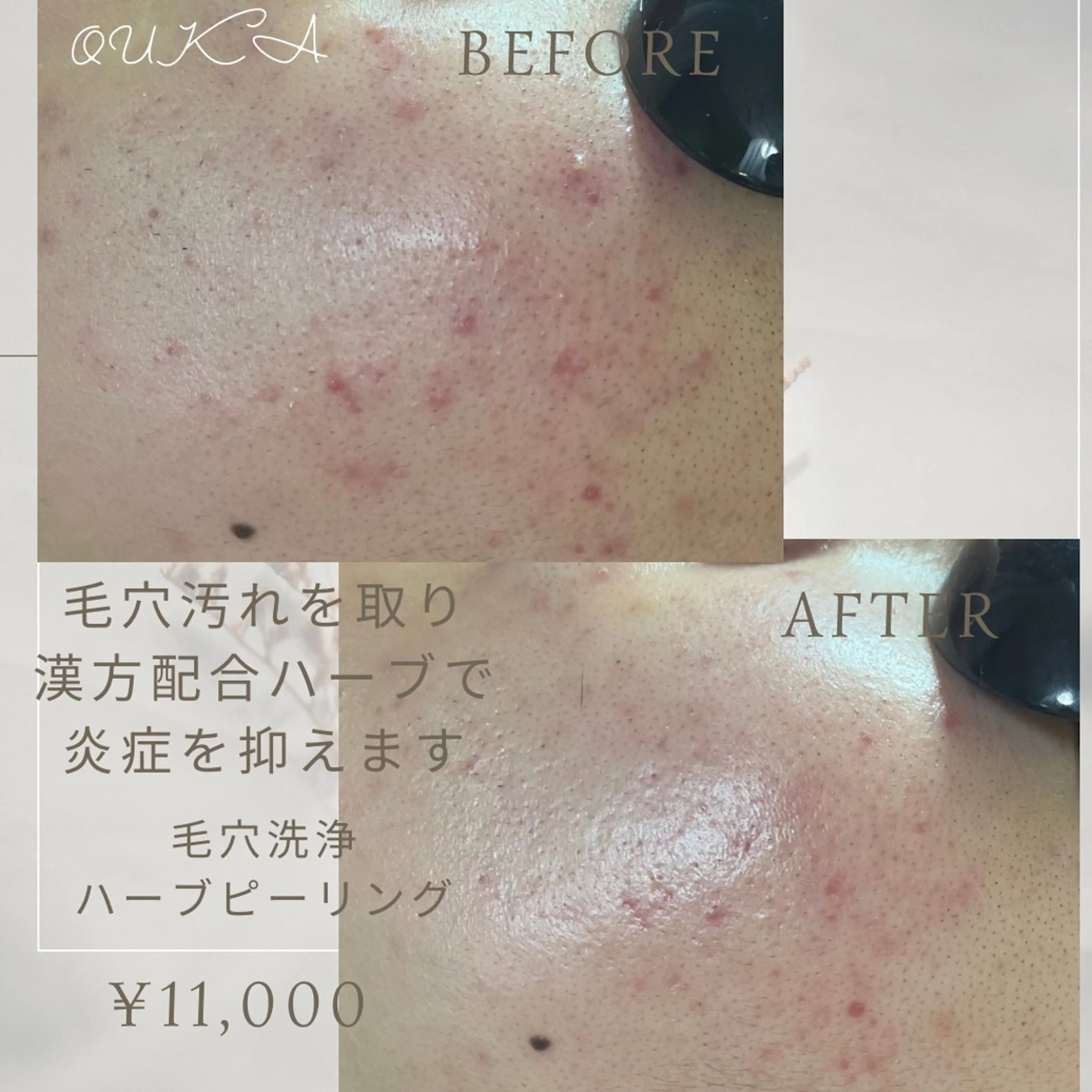 OUKA脱毛 毛穴ケアフェイシャルのエステ・リラクイメージ