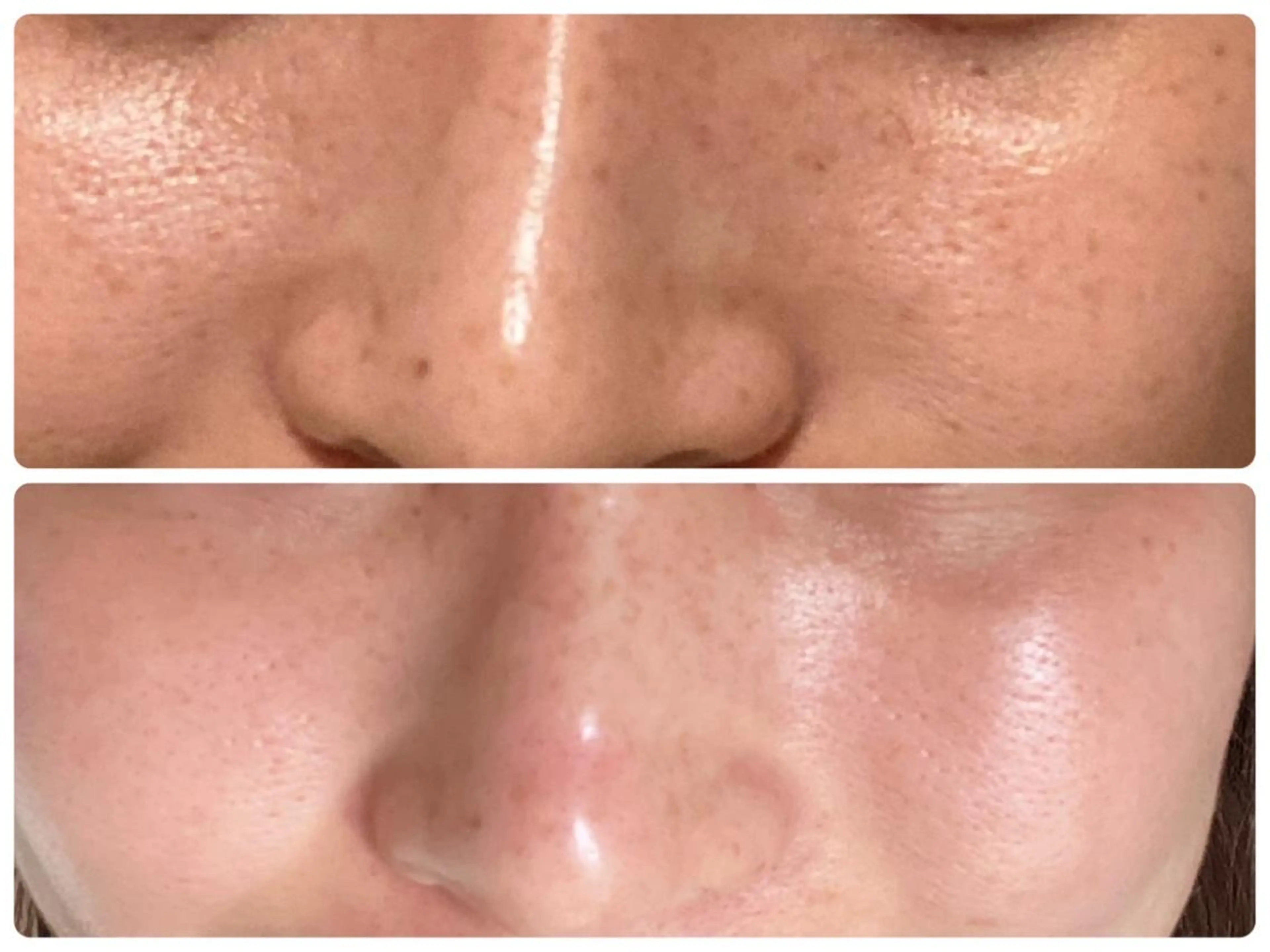 剥離なしREVIハーブピーリング（ニキビ肌、シミ、シワ）の写真