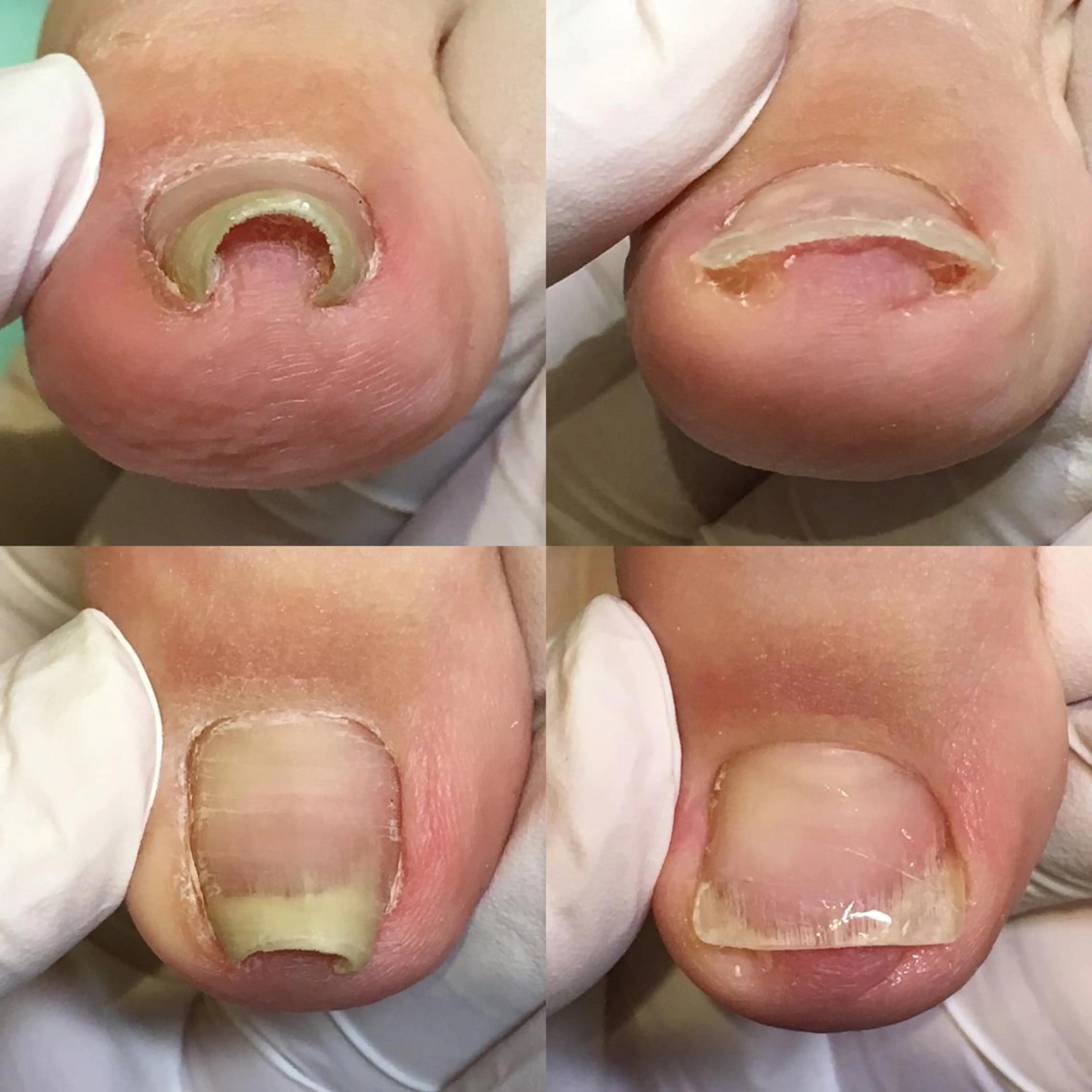 ネイル 東京巻き爪 アカデミーのエステ・リラクイメージ