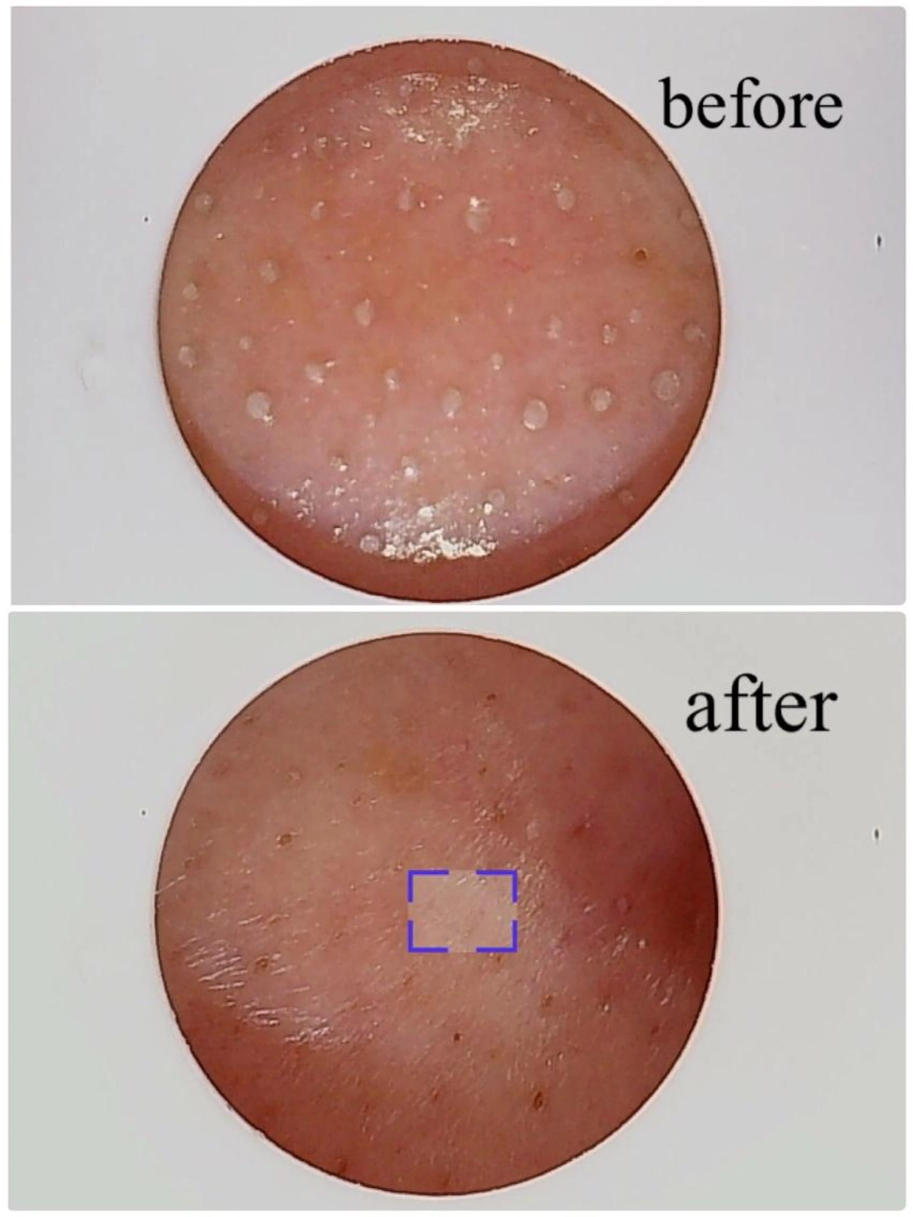 【ツルスベ肌】水素ハイドロ毛穴洗浄エステの写真