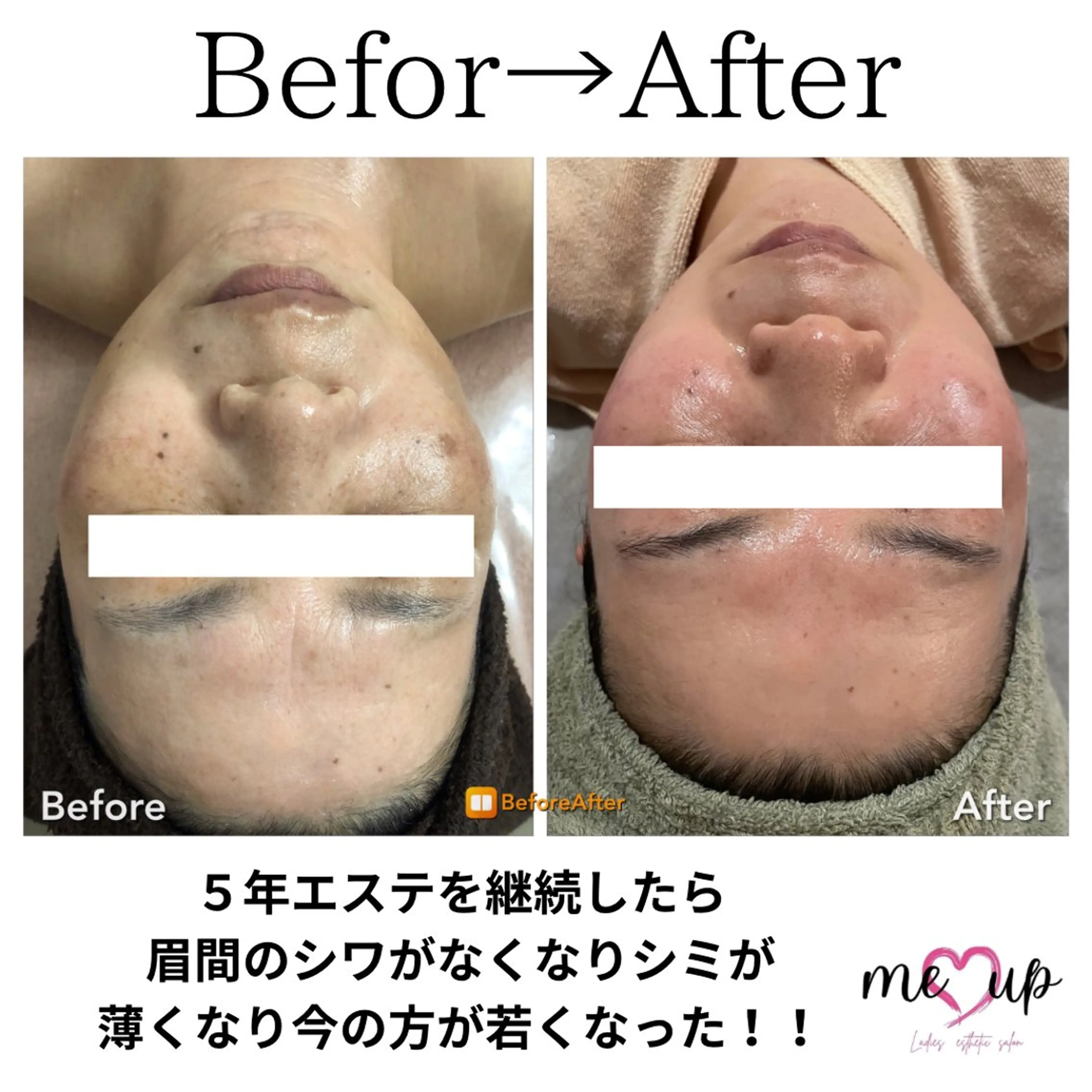 エステ Meupニキビ専門店 背中/ハーブ/肌管理のその他イメージ