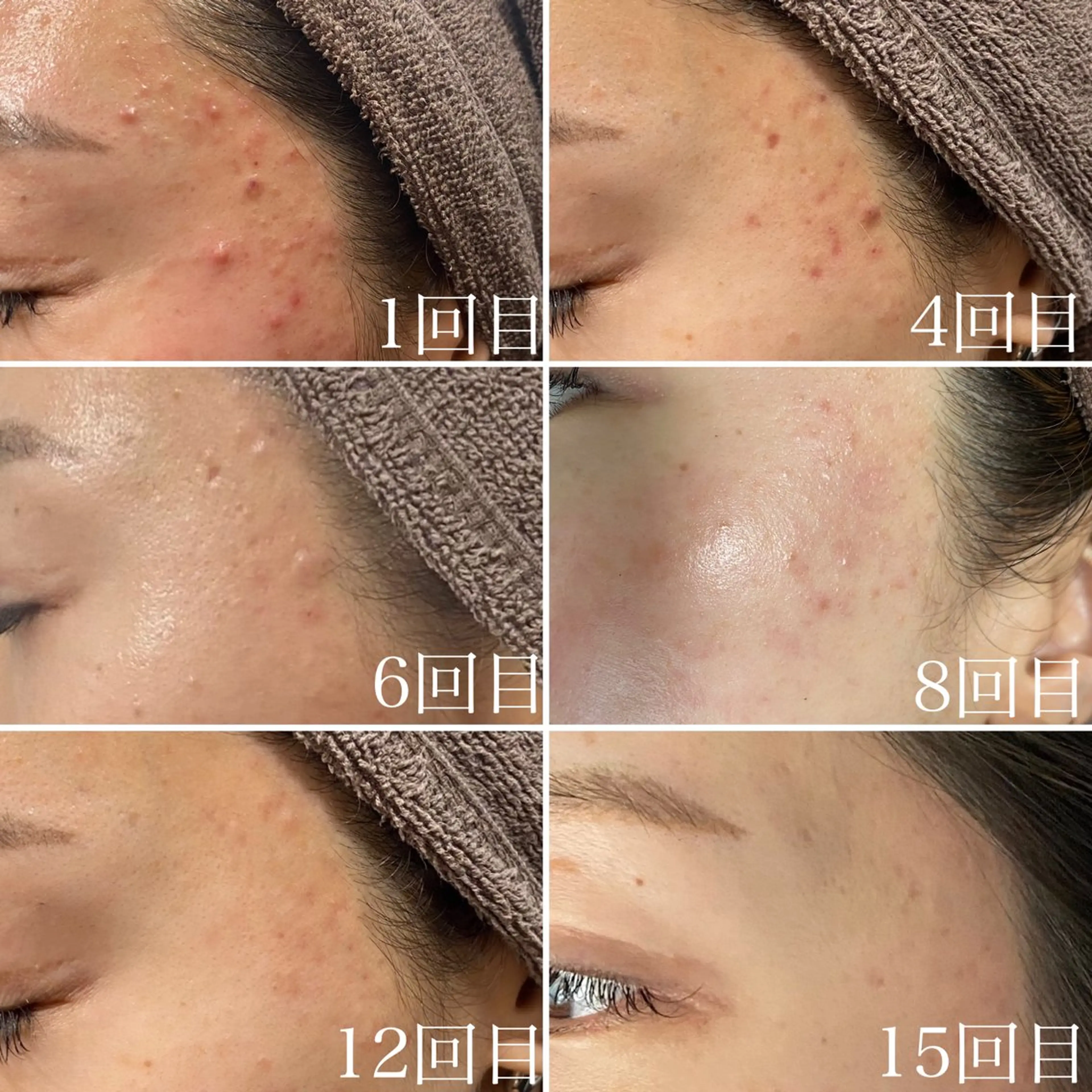 ＼施術モデル募集／【お試しピーリング3回￥18000】毛穴/シミ/ニキビ/くすみ/肌質改善/フェイシャル横浜の写真