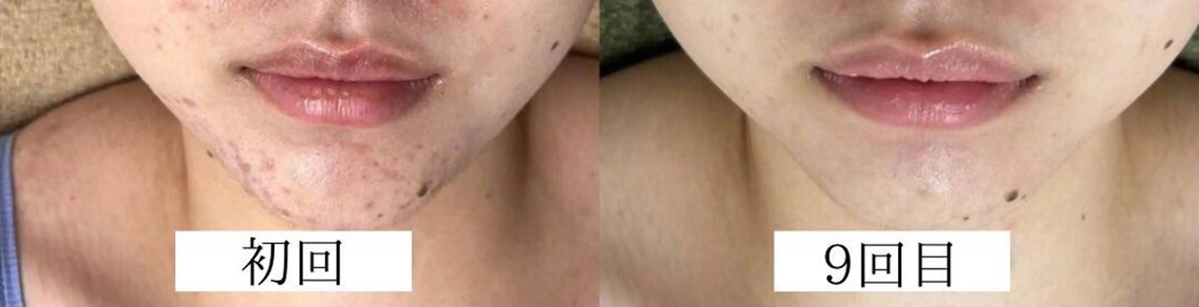 韓国美肌/肌質改善 【天神】のエステ・リラクイメージ