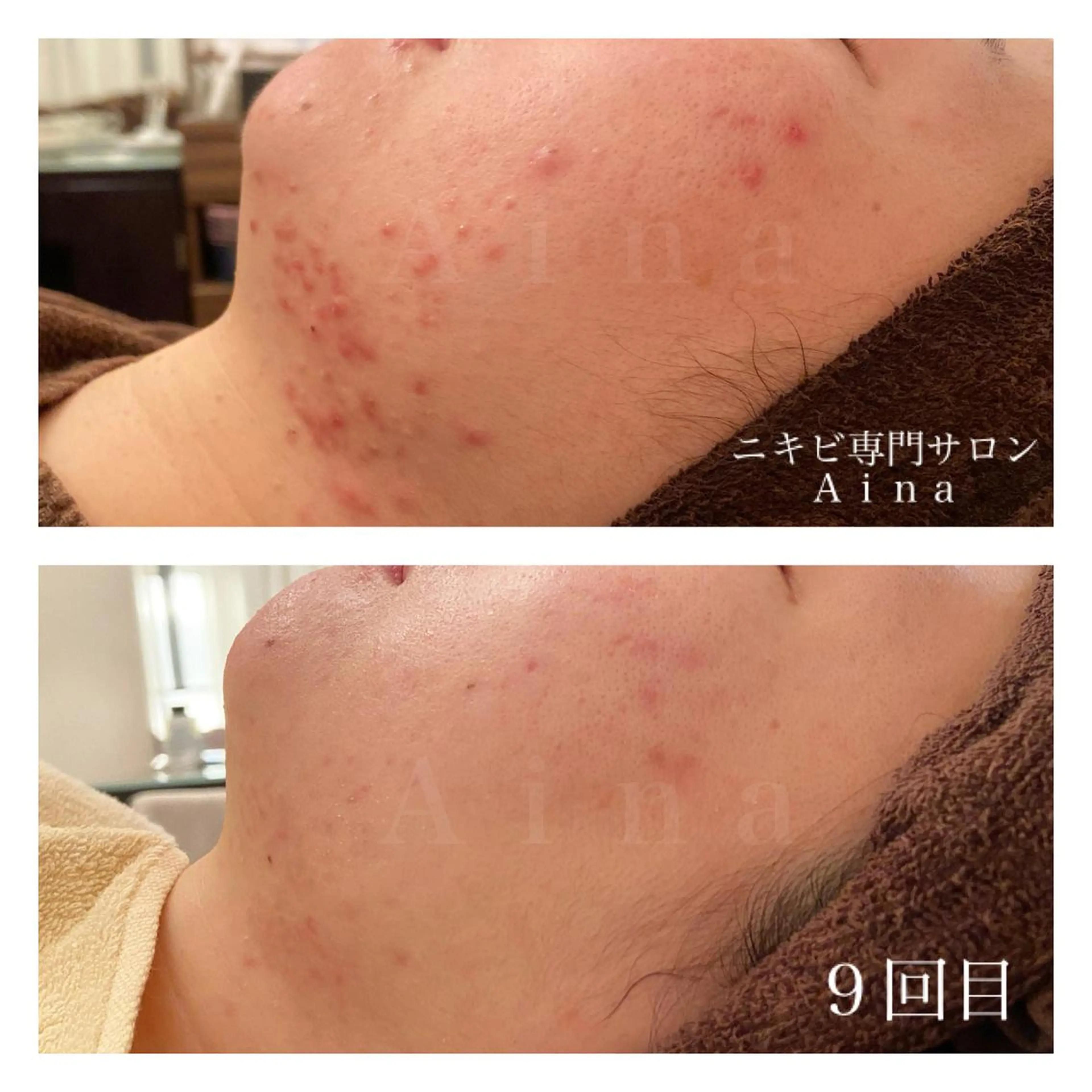 ショート パーマ ヘアアレンジ メンズ キッズ ネイル マツエク・マツパ 赤色 エステ リラク ニキビ跡専門サロン Ainaのエステ・リラクイメージ