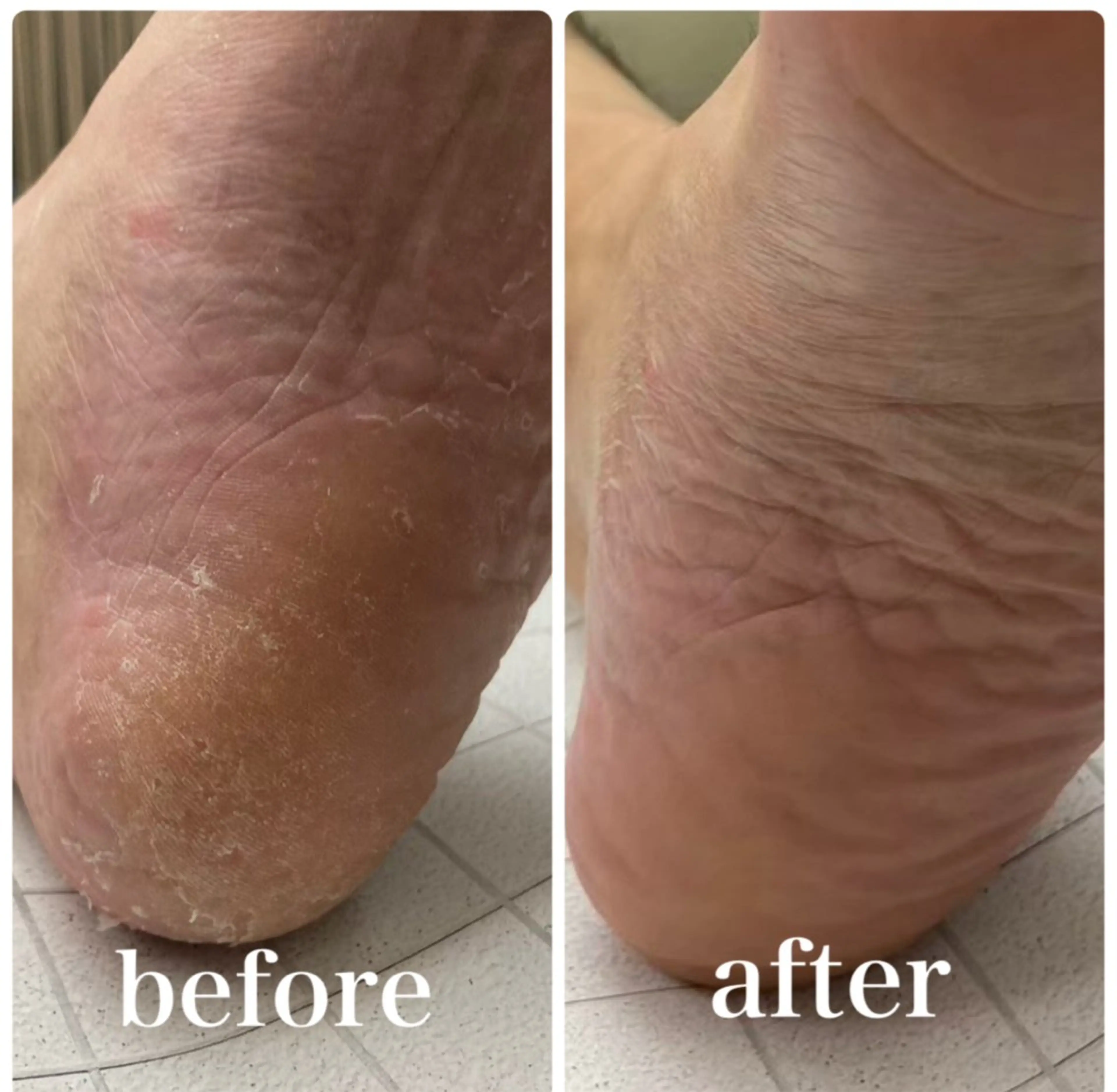 足裏美人🦶　角質ケア＋爪カットorマッサージ　(ひび割れ、厚い角質、外反母趾等による角質ケア)の写真