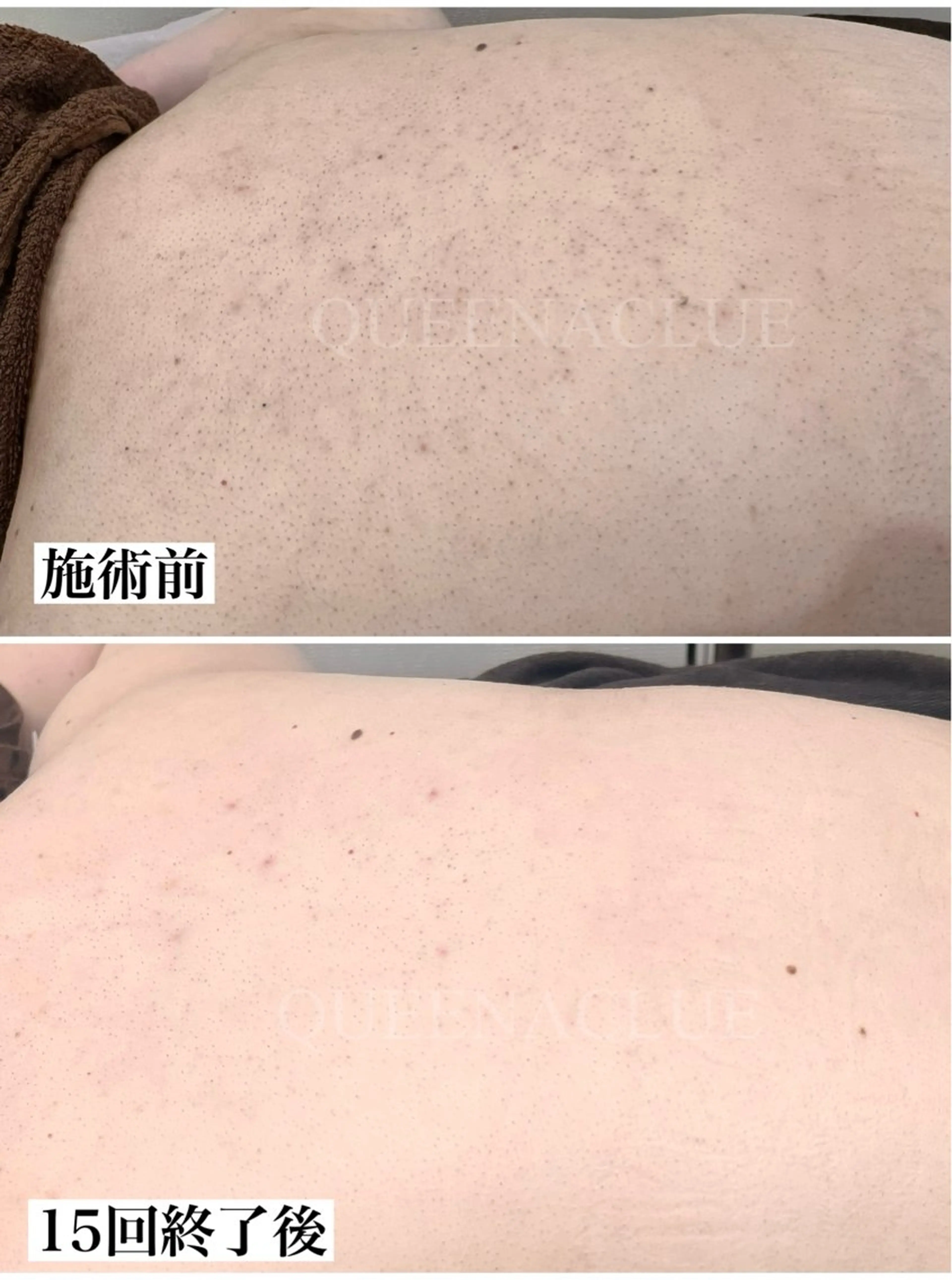 脱毛 毛穴改善/脱毛 ネイル　川上久仁子のエステ・リラクイメージ