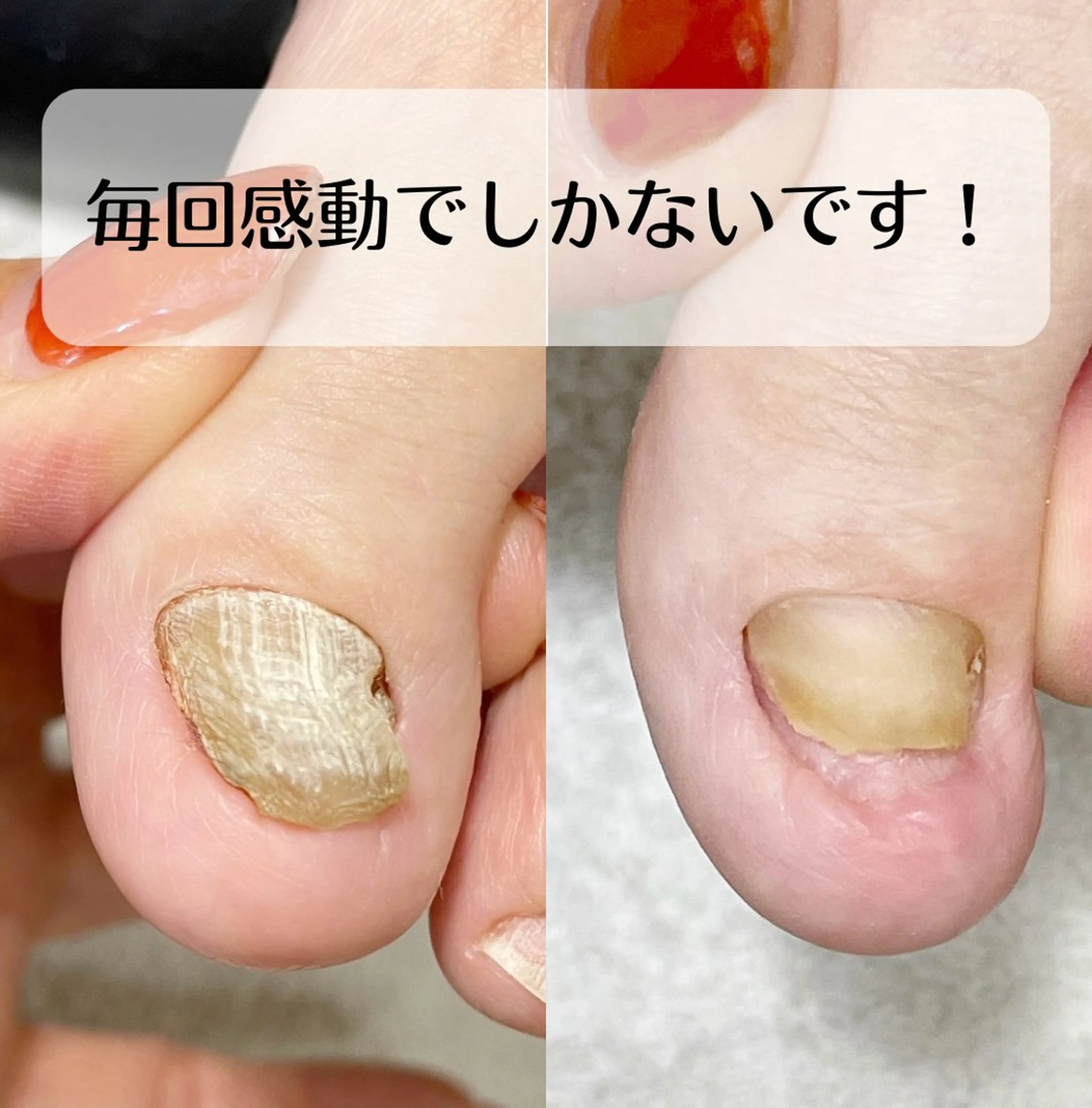 ネイル 深爪・巻き爪 専門サンセリテのネイルデザイン